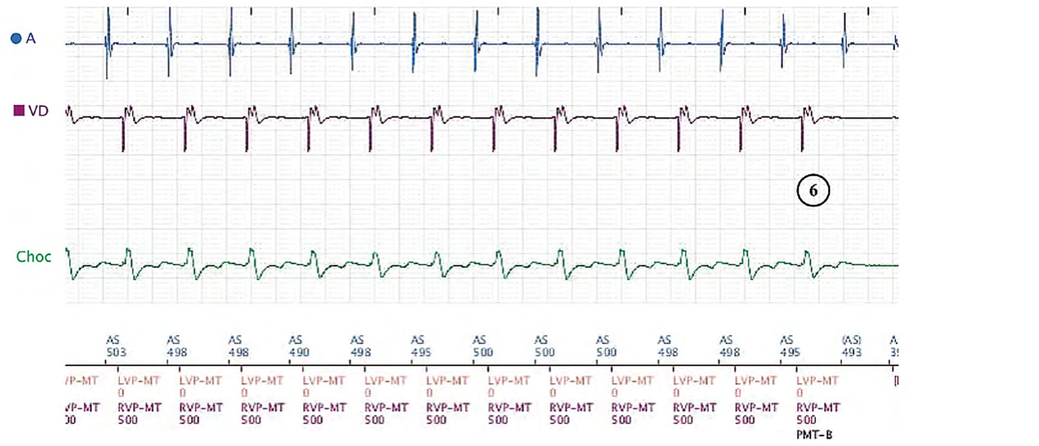 Boston Scientific CRT electrogram, segment 3/8 — Sinus tachycardia, Wenckebach and pro-arrhythmia