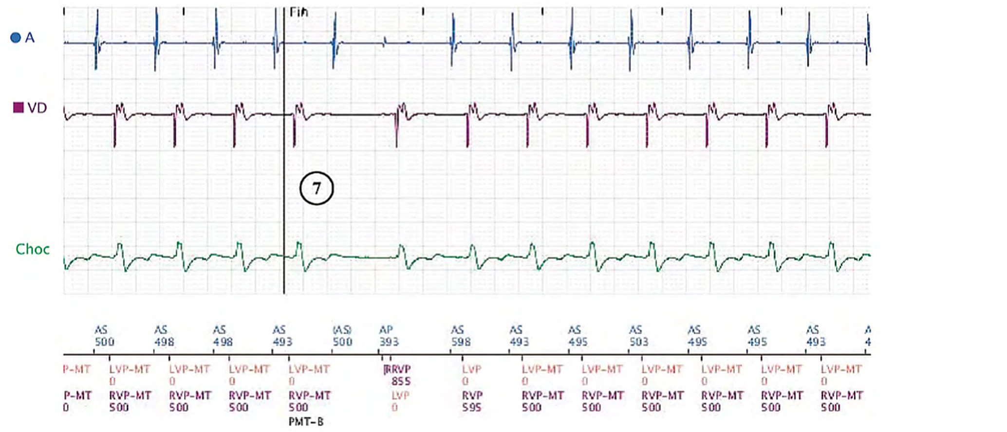 Boston Scientific CRT electrogram, segment 4/8 — Sinus tachycardia, Wenckebach and pro-arrhythmia
