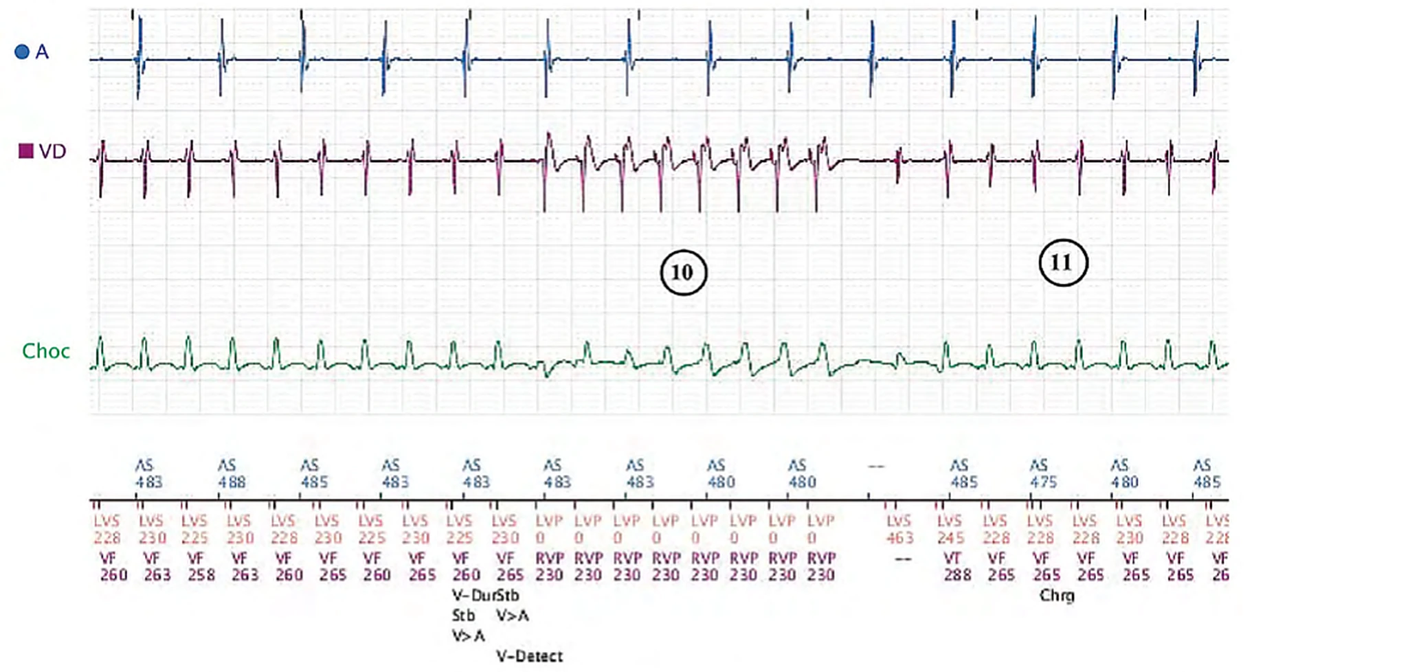 Boston Scientific CRT electrogram, segment 8/8 — Sinus tachycardia, Wenckebach and pro-arrhythmia