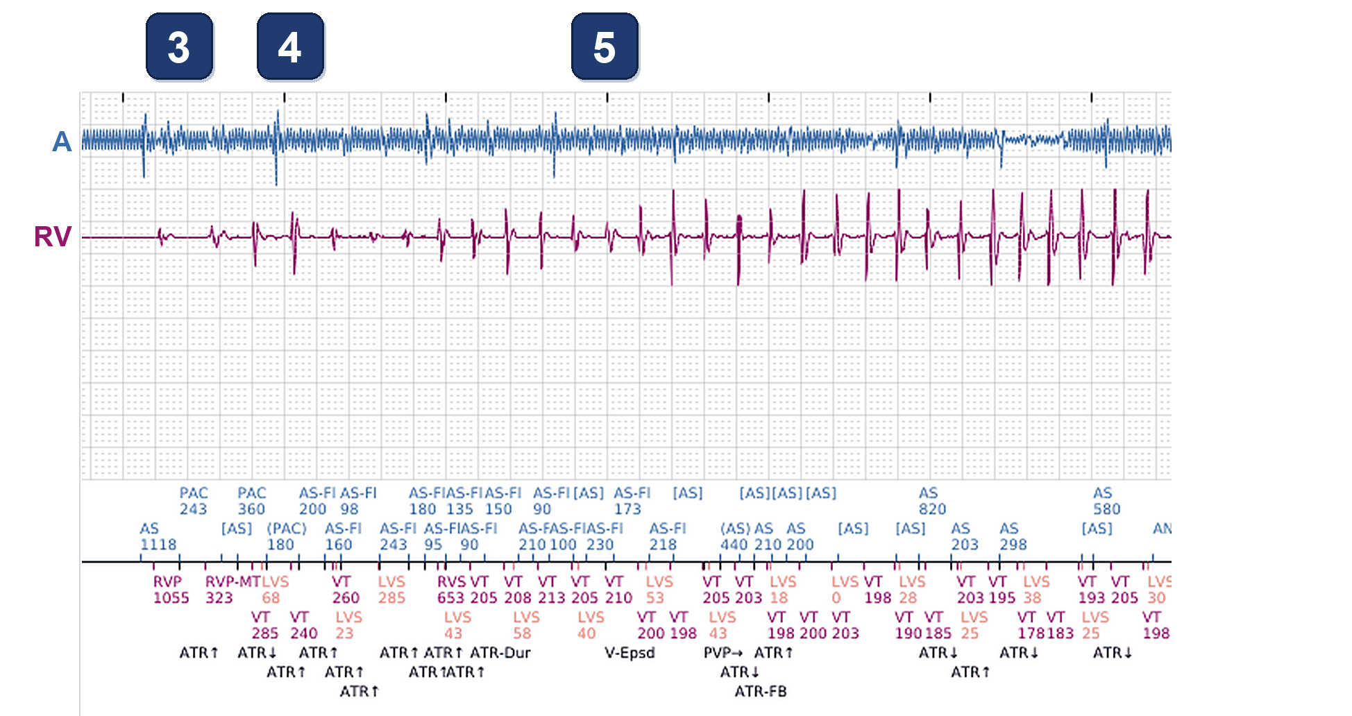 Boston Scientific CRT electrogram, segment 3/11 — Ventricular episodes in a CRT-P: what started them?