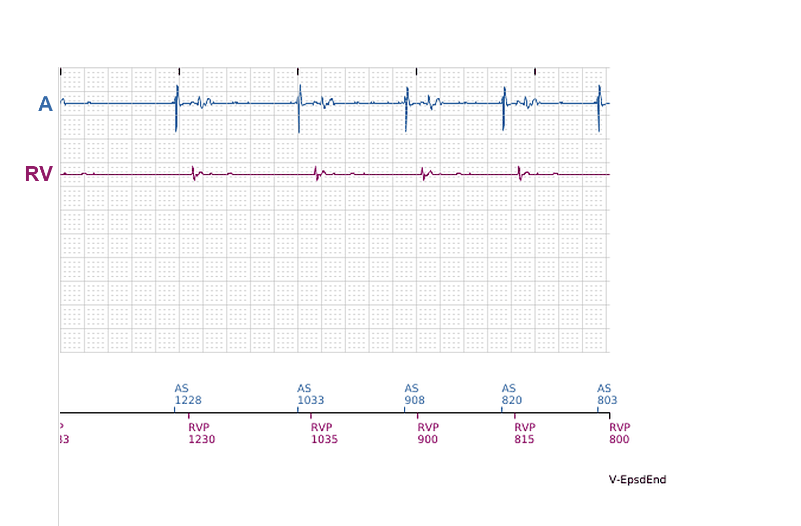 Boston Scientific CRT electrogram, segment 6/11 — Ventricular episodes in a CRT-P: what started them?