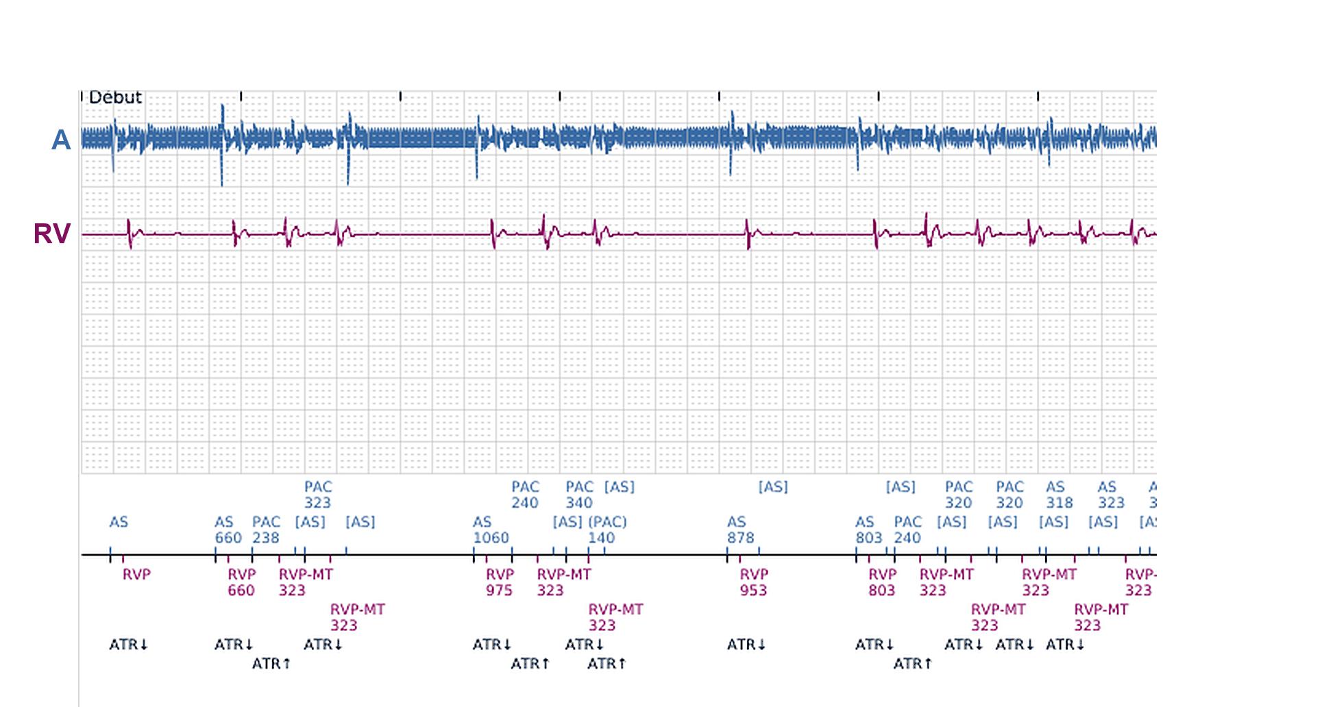 Boston Scientific CRT electrogram, segment 8/11 — Ventricular episodes in a CRT-P: what started them?