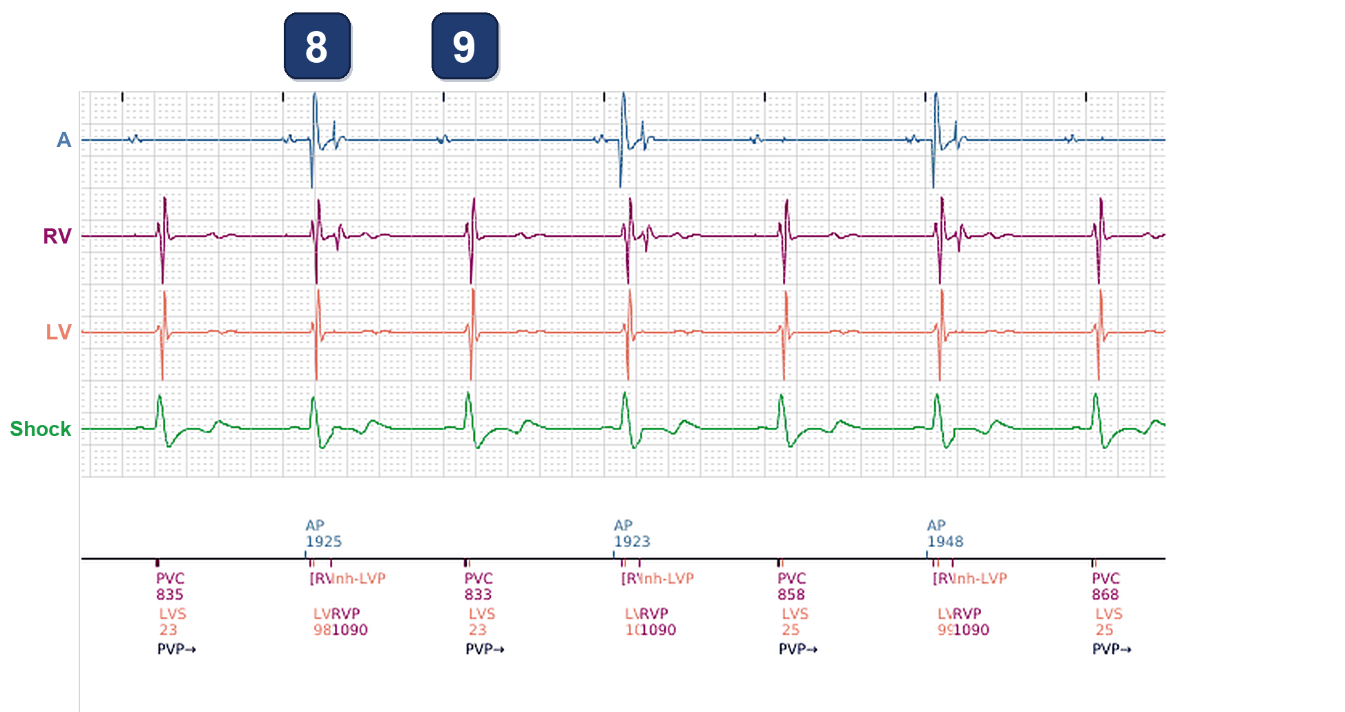 Boston Scientific CRT electrogram, segment 4/4 — CRT drop and low-amplitude atrial events