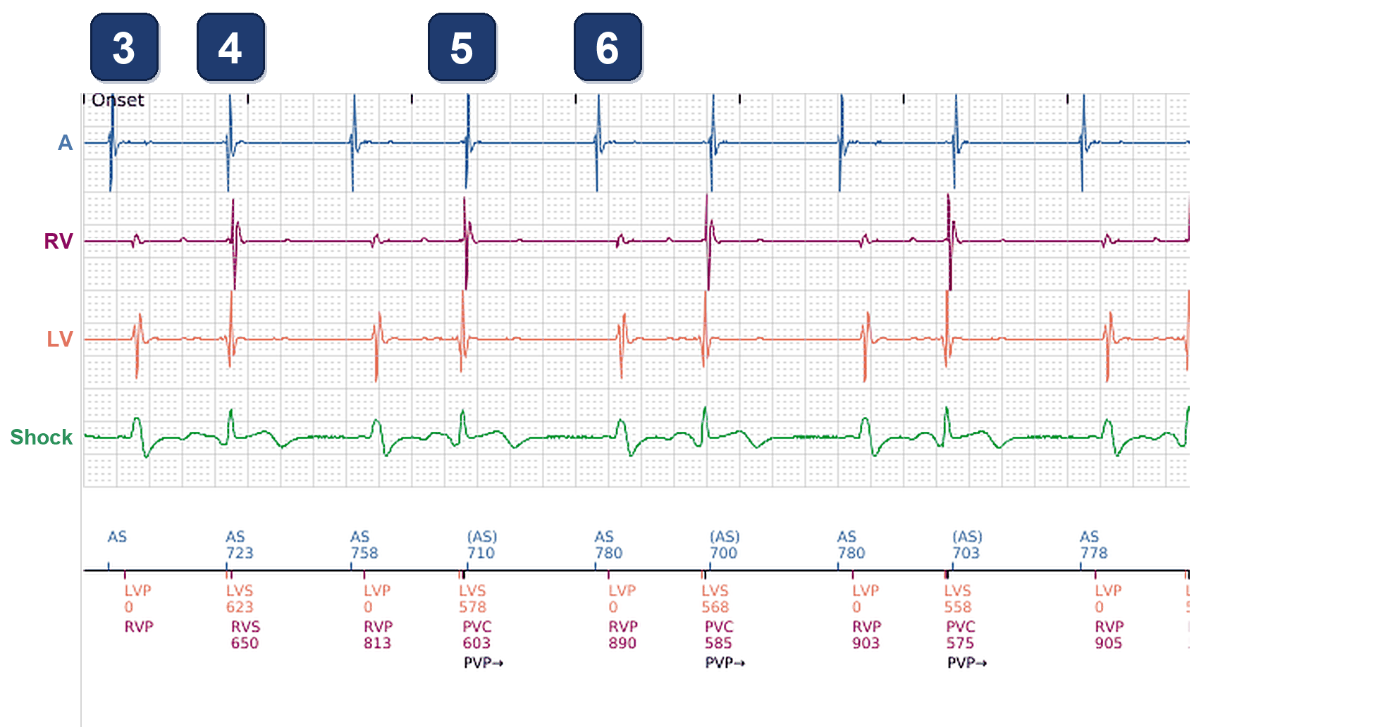 Boston Scientific CRT electrogram, segment 2/5 — CRT pacing alert at 57%, and 2 years later