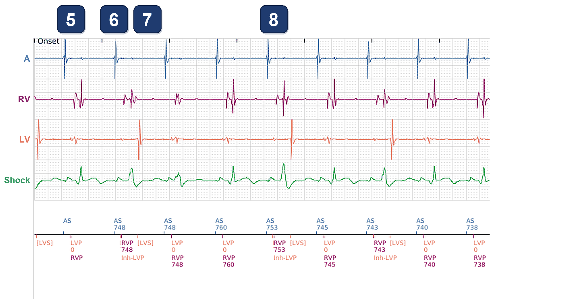Boston Scientific CRT electrogram, segment 3/3 — RV paced 100%, LV only 86%