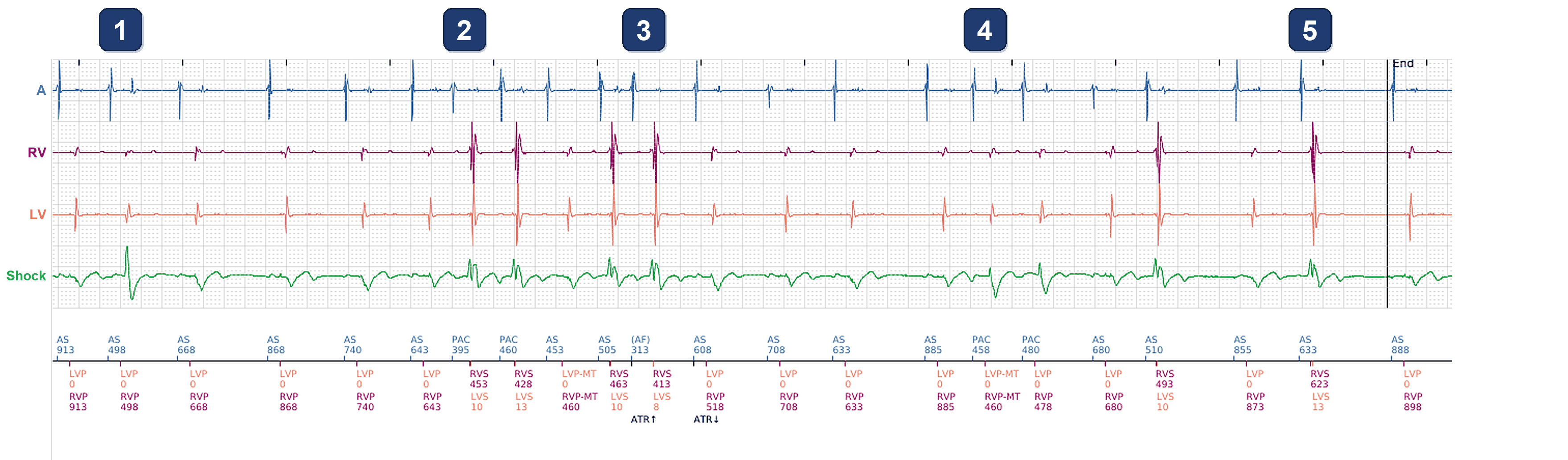 Boston Scientific CRT electrogram, segment 1/4 — CRT drop in a patient with atrial ectopy