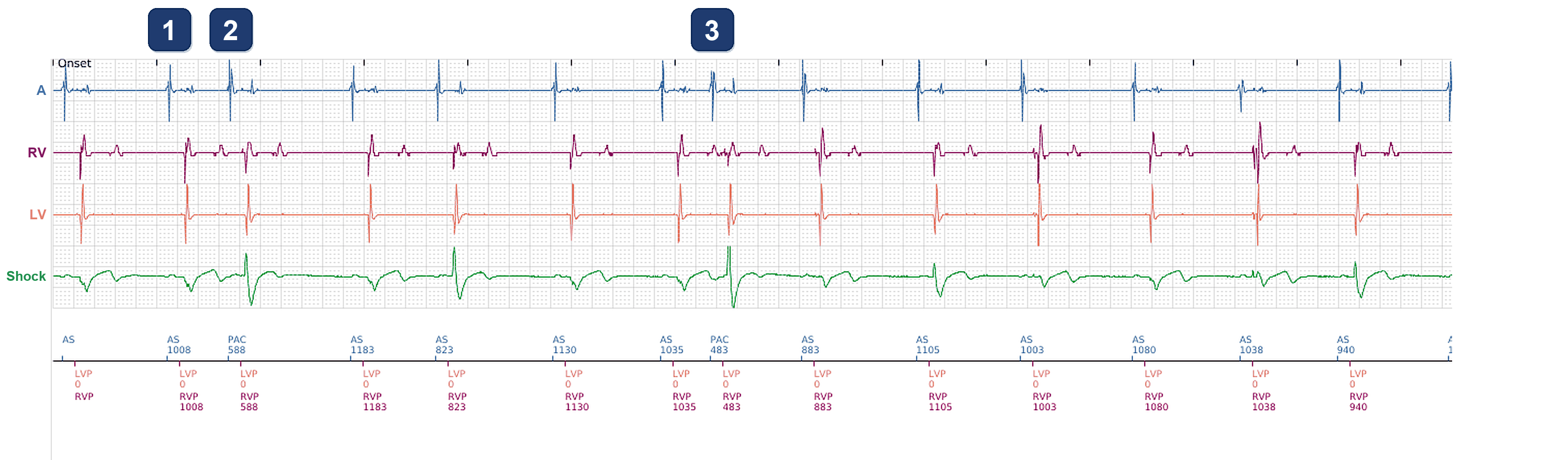 Boston Scientific CRT electrogram, segment 3/4 — CRT drop in a patient with atrial ectopy