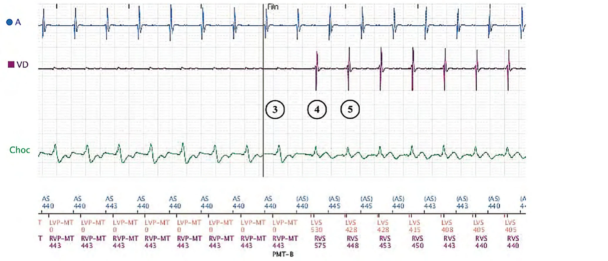 Boston Scientific CRT electrogram, segment 2/3 — Exercise, anti-PMT algorithm and long PR