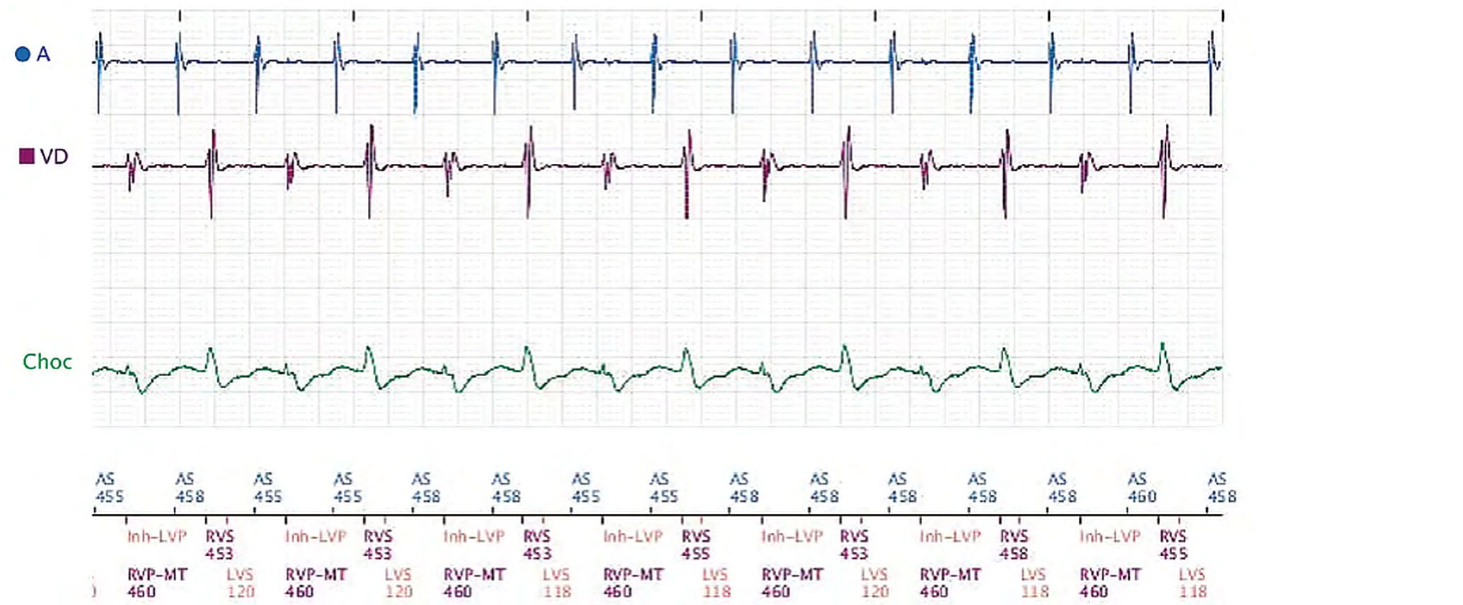 Boston Scientific CRT electrogram, segment 3/3 — Exercise, anti-PMT algorithm and LV sensing