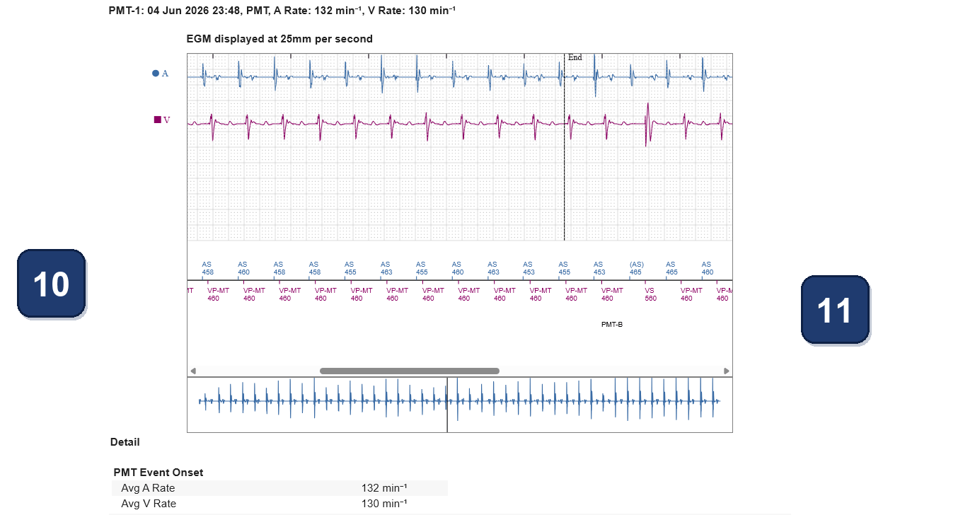 Boston Scientific CRT electrogram, segment 13/13 — CRT with a dual chamber pacemaker using LBBAP