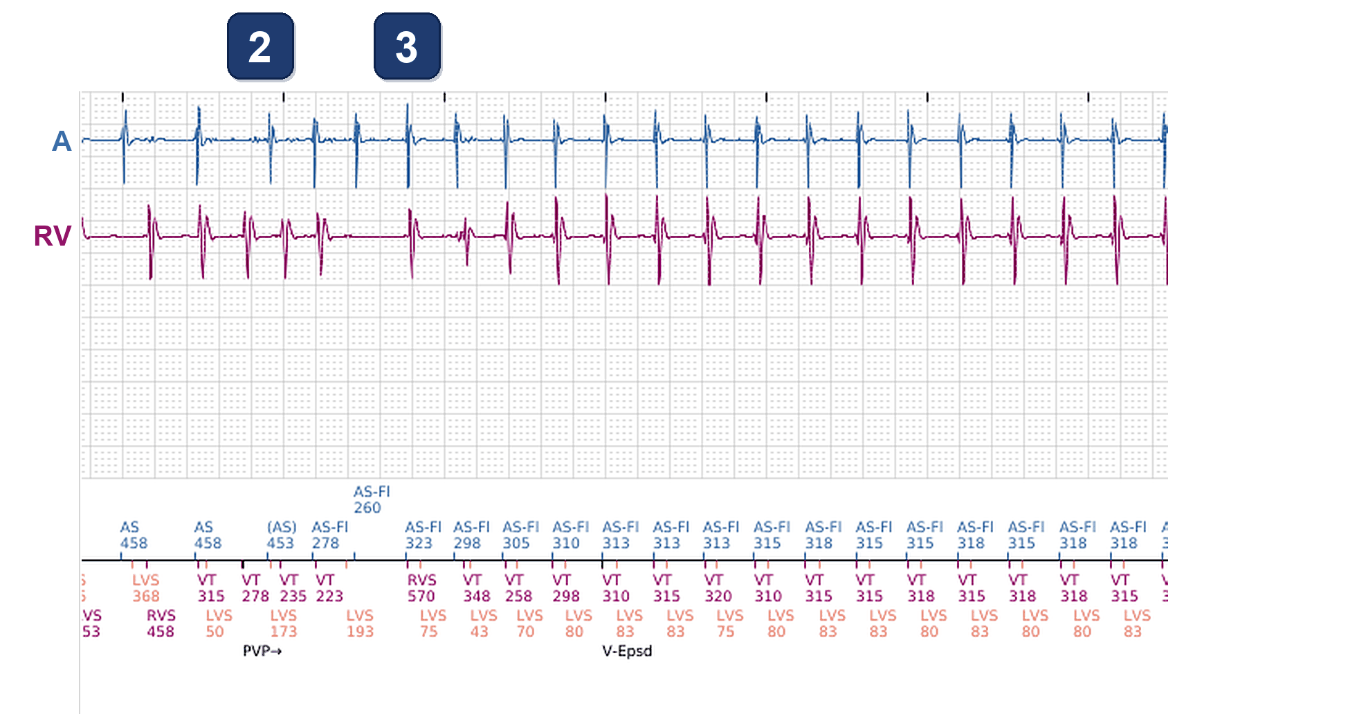 Boston Scientific CRT electrogram, segment 2/12 — Tachycardia while dancing: what the CRT-P and the S-ICD saw