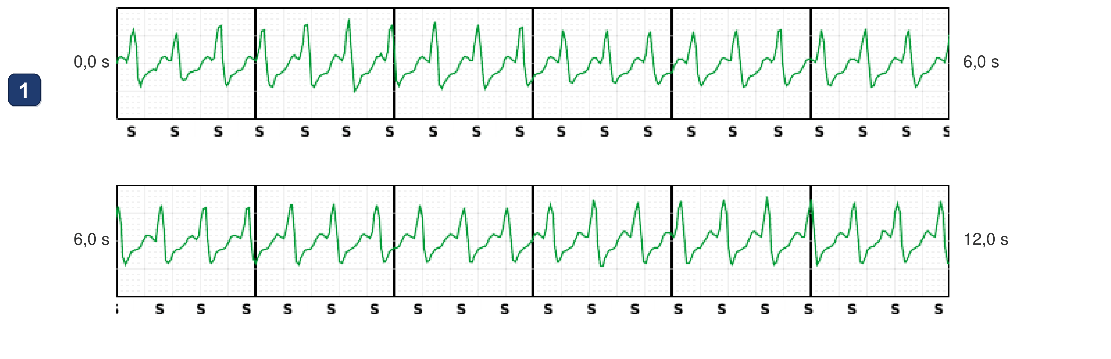 Boston Scientific CRT electrogram, segment 6/12 — Tachycardia while dancing: what the CRT-P and the S-ICD saw