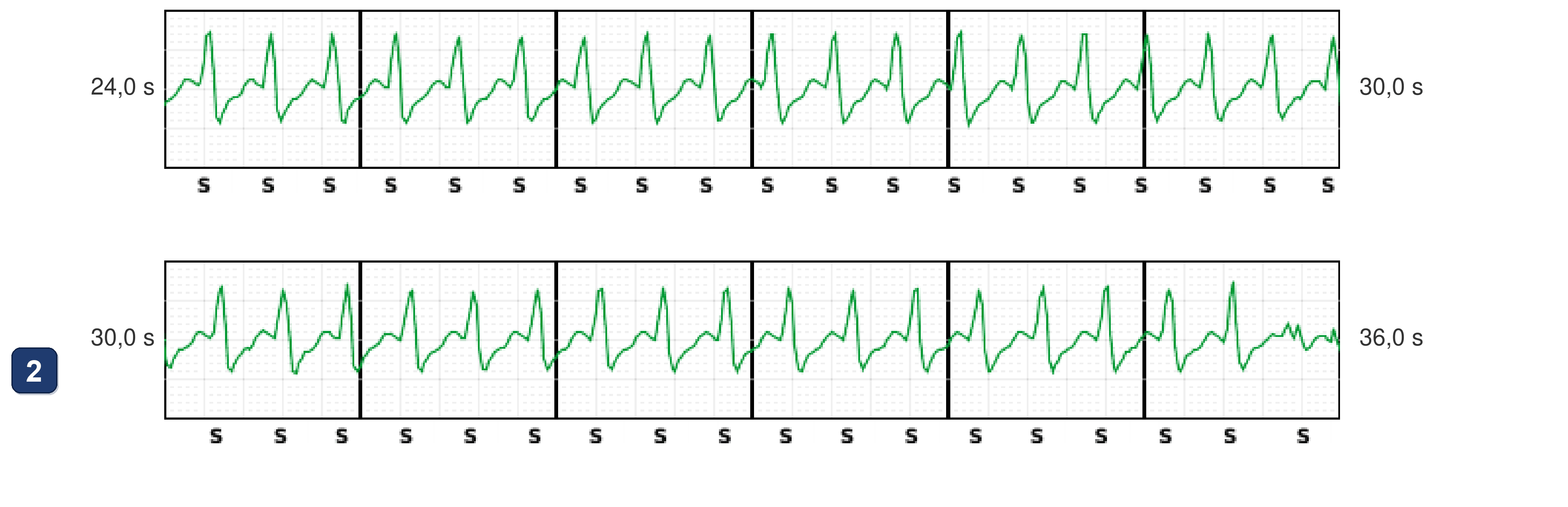 Boston Scientific CRT electrogram, segment 8/12 — Tachycardia while dancing: what the CRT-P and the S-ICD saw