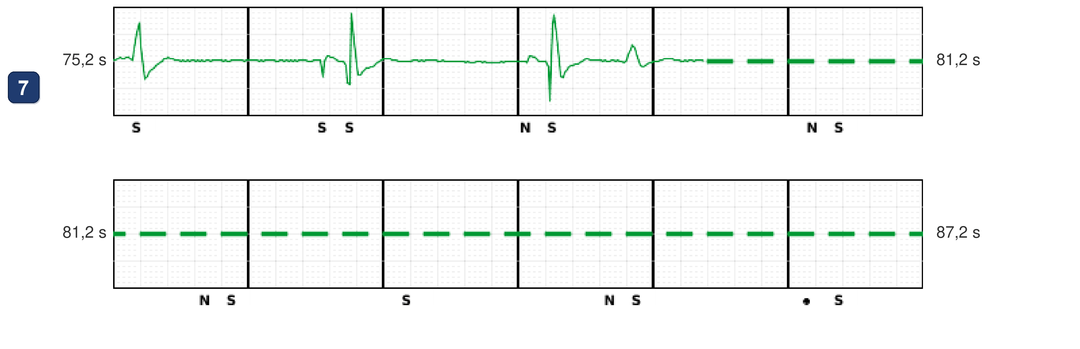 Boston Scientific CRT electrogram, segment 12/12 — Tachycardia while dancing: what the CRT-P and the S-ICD saw