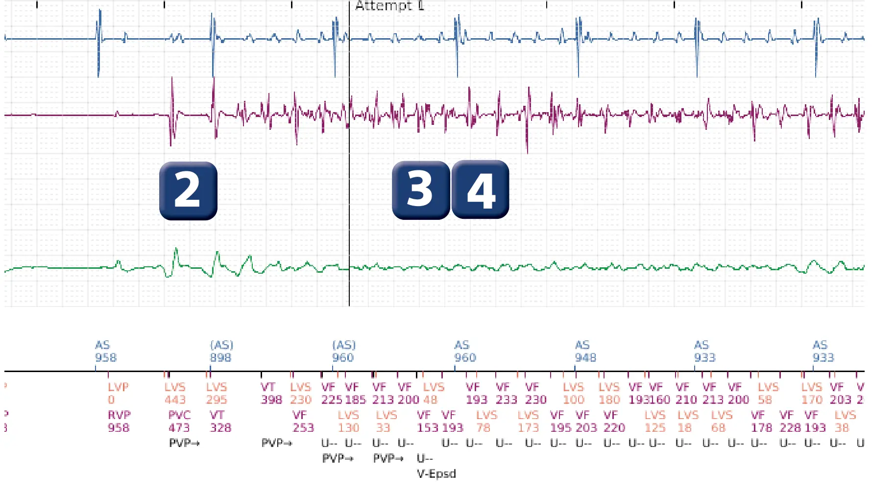 Boston Scientific ICD electrogram, segment 2 of 6 — Detection and treatment of a VF episode