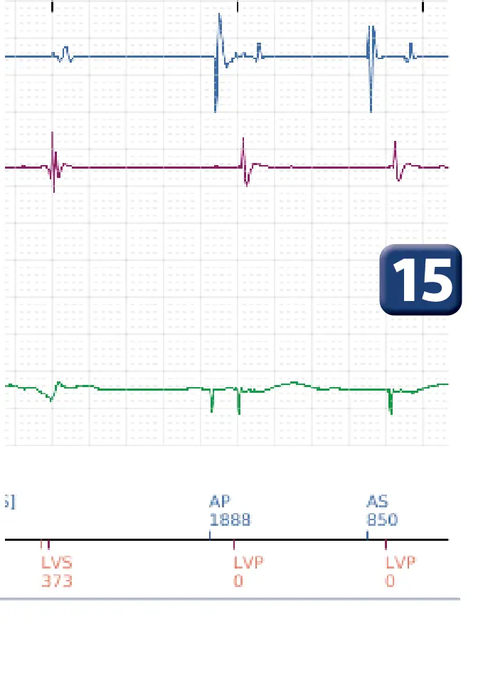 Boston Scientific ICD electrogram, segment 6 of 6 — Detection and treatment of a VF episode