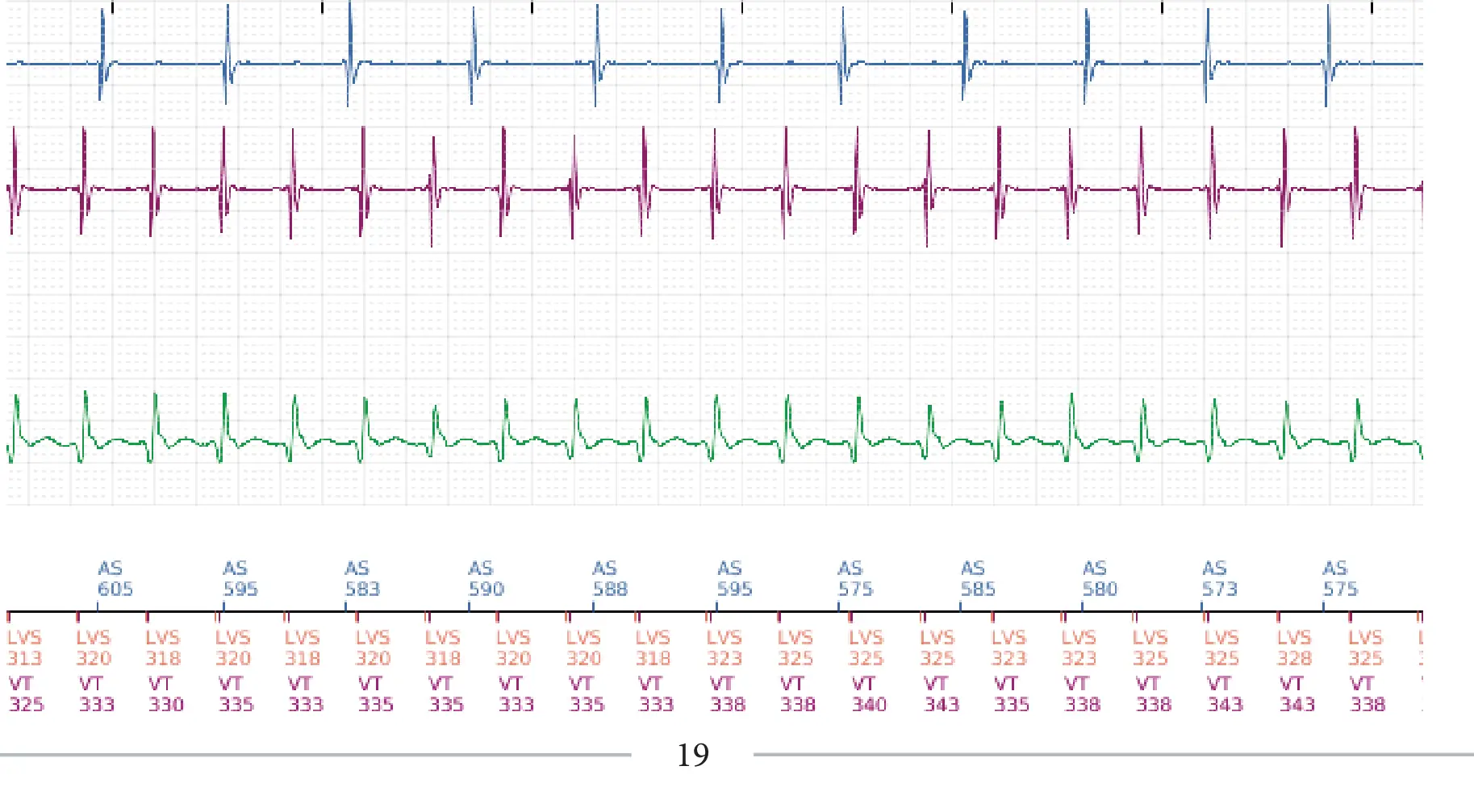 Boston Scientific ICD electrogram, segment 3 of 5 — Detection and treatment of a VT episode