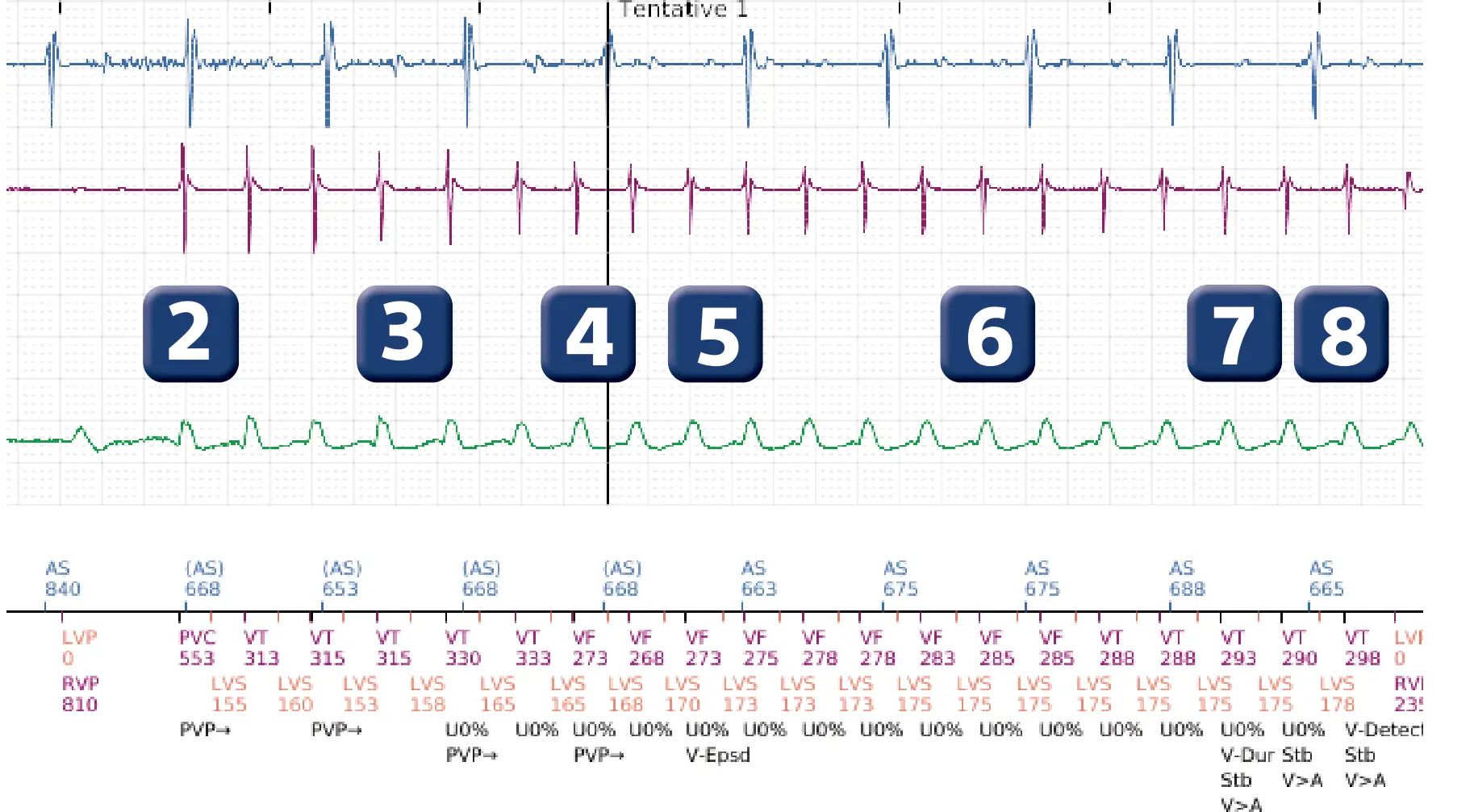 Boston Scientific ICD electrogram, segment 2 of 6 — Change of detection zone