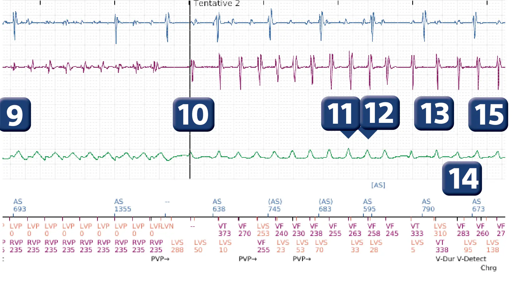 Boston Scientific ICD electrogram, segment 3 of 6 — Change of detection zone