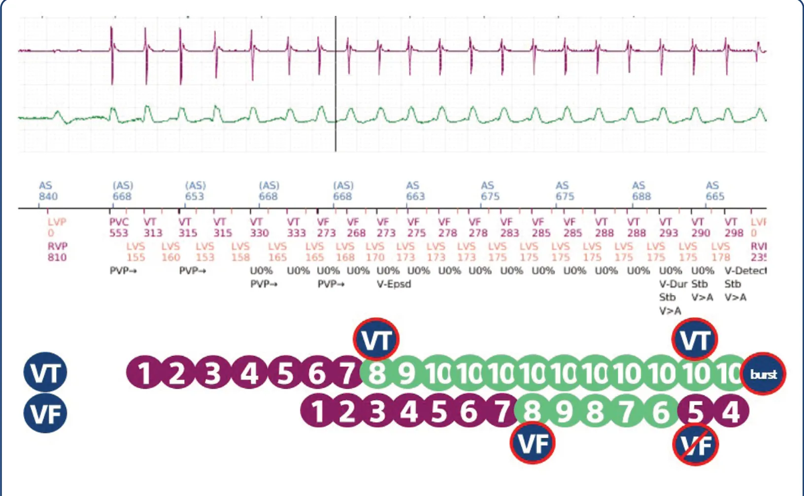 This figure shows that the 8/10 criterion for the VT zone is initially met, then this criterion is also met for the VF zone; at the end of the VT zone duration, the VF zone duration is still active and VT zone therapies are not delivered; the 6/10 criterion for the VF zone is then no longer fulfilled and the burst (first programmed VT zone