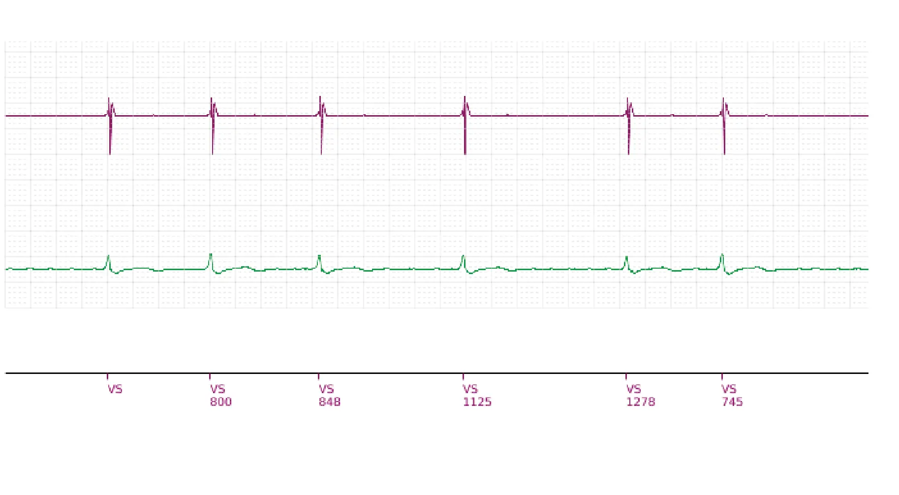 Boston Scientific ICD electrogram, segment 1 of 4 — Spontaneous termination and shock diversion