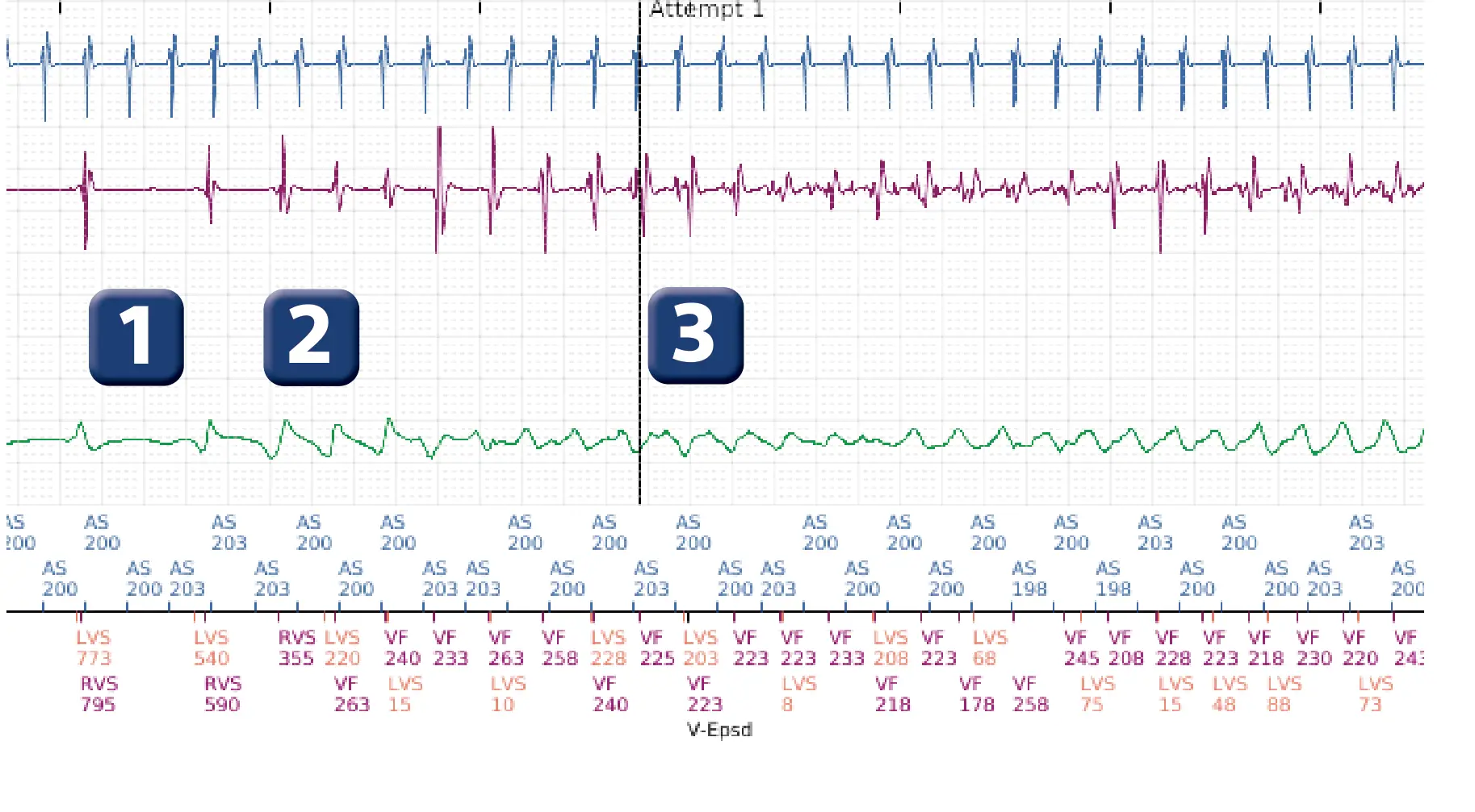 Boston Scientific ICD electrogram, segment 1 of 4 — Diversion window at end of a charge