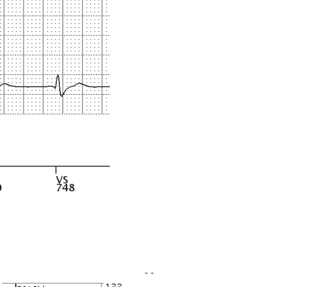 Figure — Undersensing and charge diversion