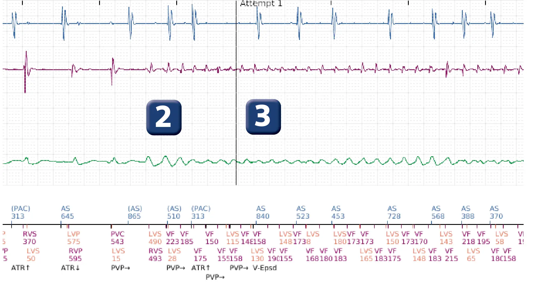 Boston Scientific ICD electrogram, segment 2 of 17 — End-of-episode criteria following an electric shock