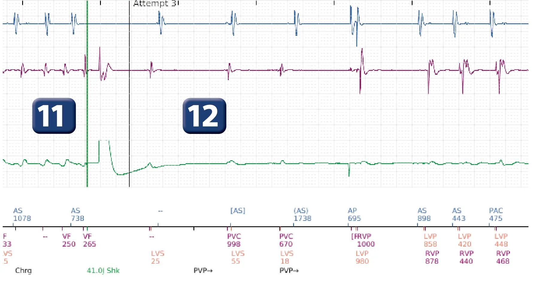 Boston Scientific ICD electrogram, segment 6 of 17 — End-of-episode criteria following an electric shock