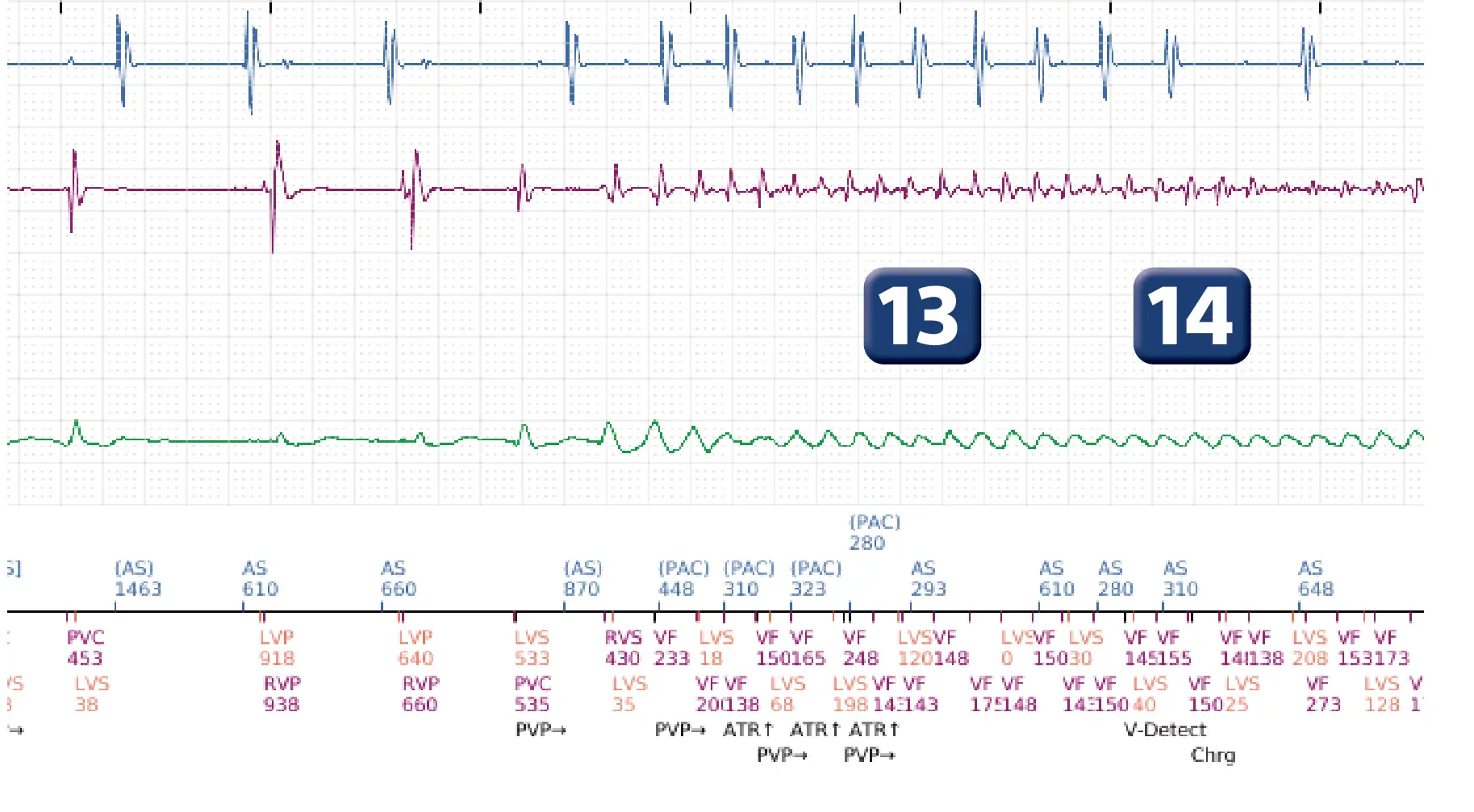 Boston Scientific ICD electrogram, segment 8 of 17 — End-of-episode criteria following an electric shock