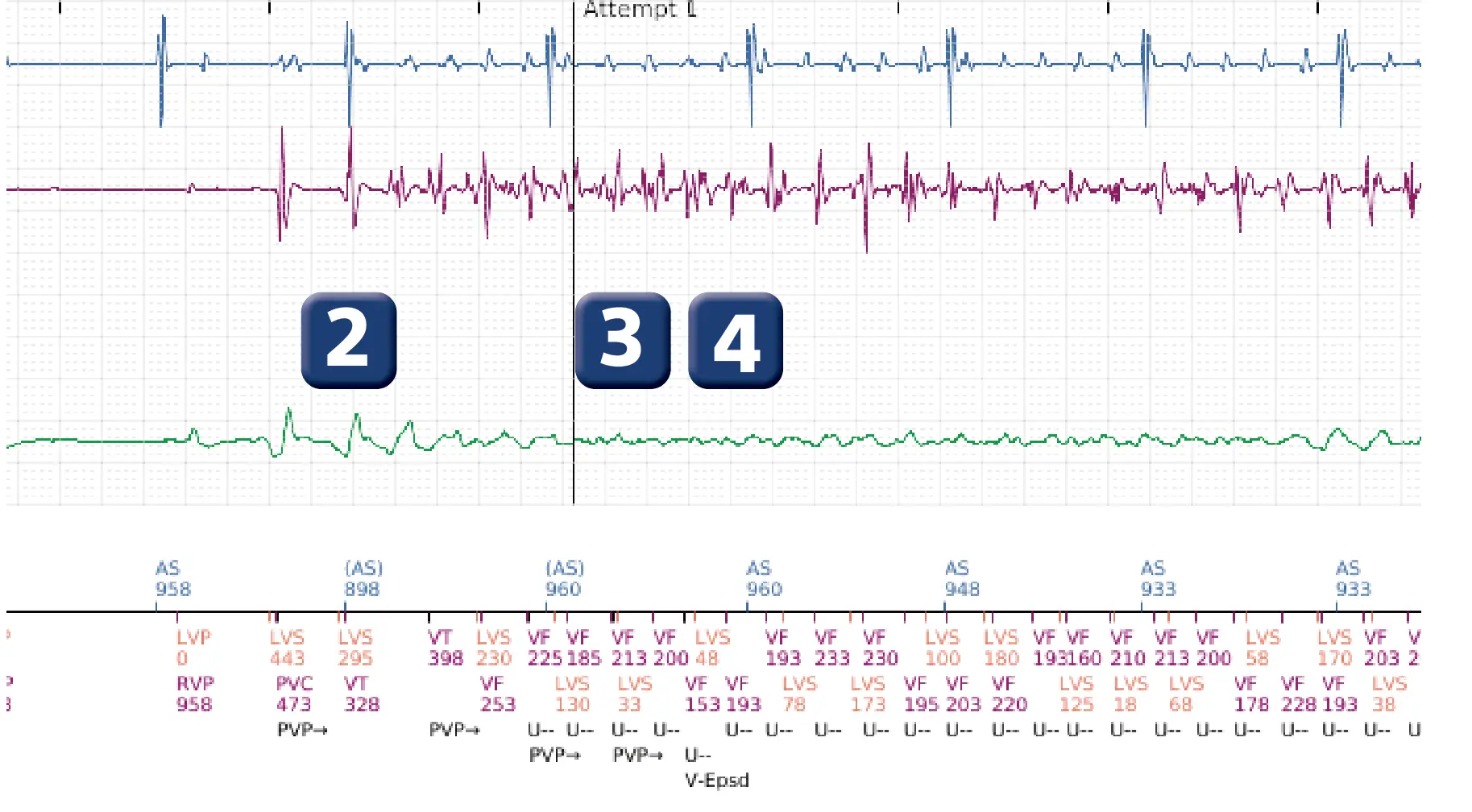 Boston Scientific ICD electrogram, segment 2 of 5 — VF episode correctly detected and treated with maximum output shock