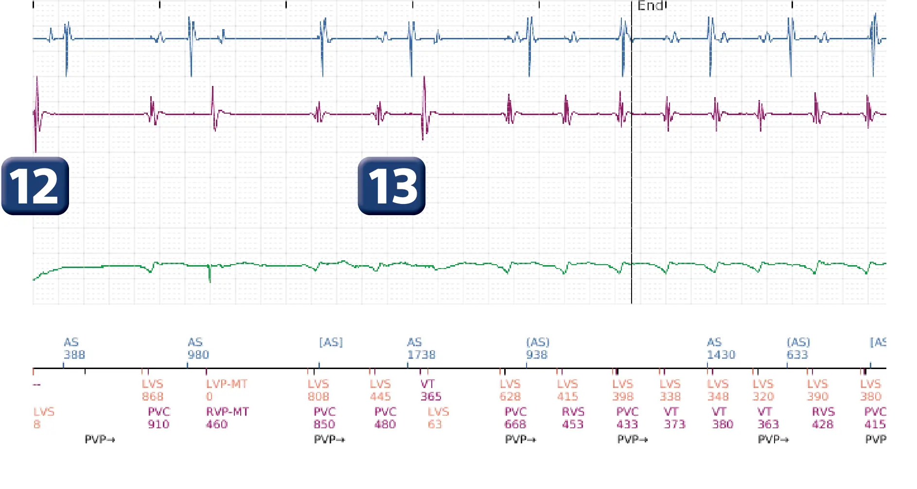 Boston Scientific ICD electrogram, segment 5 of 5 — VF episode correctly detected and treated with maximum output shock