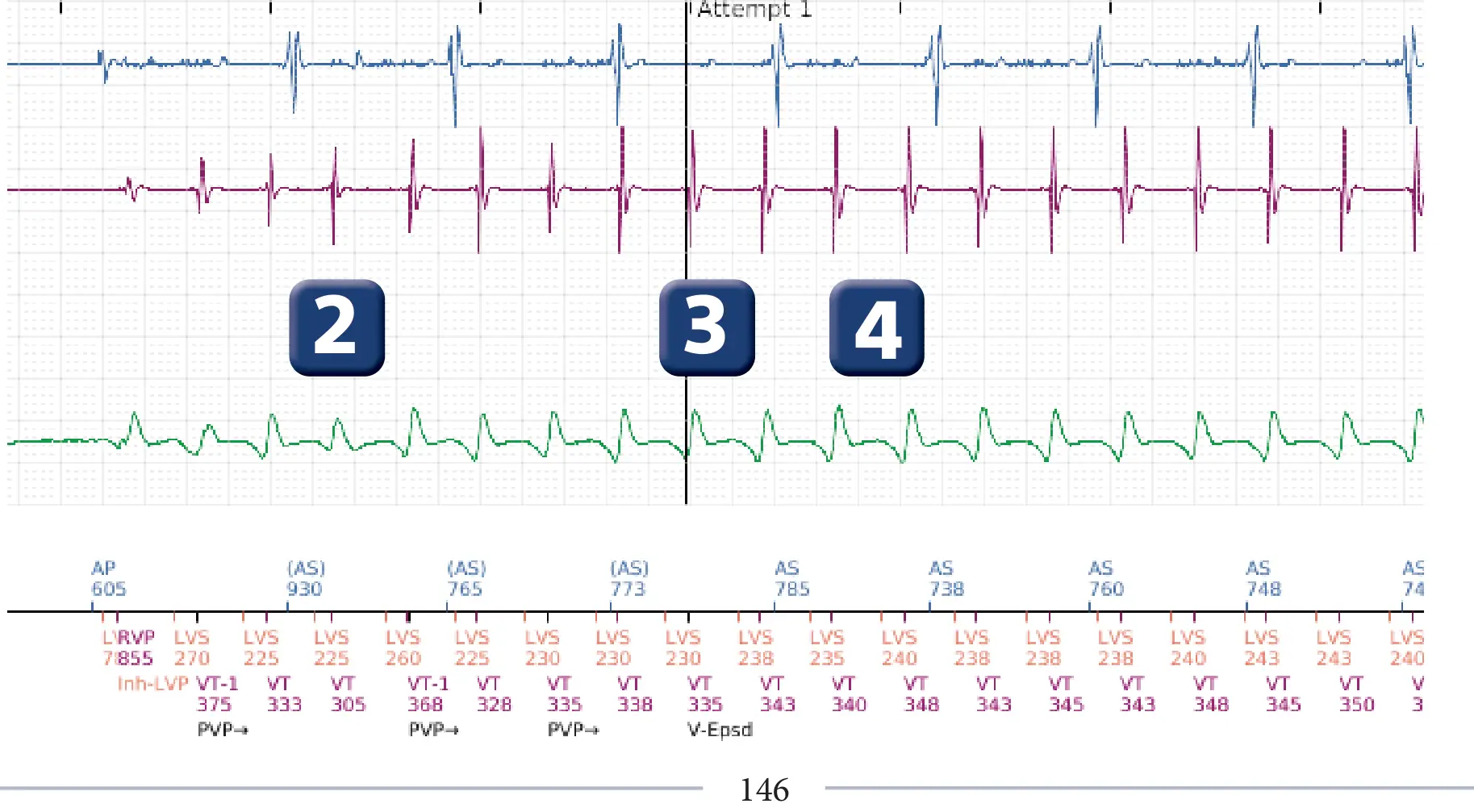 Boston Scientific ICD electrogram, segment 2 of 5 — Anti-tachycardia pacing in the VT zone