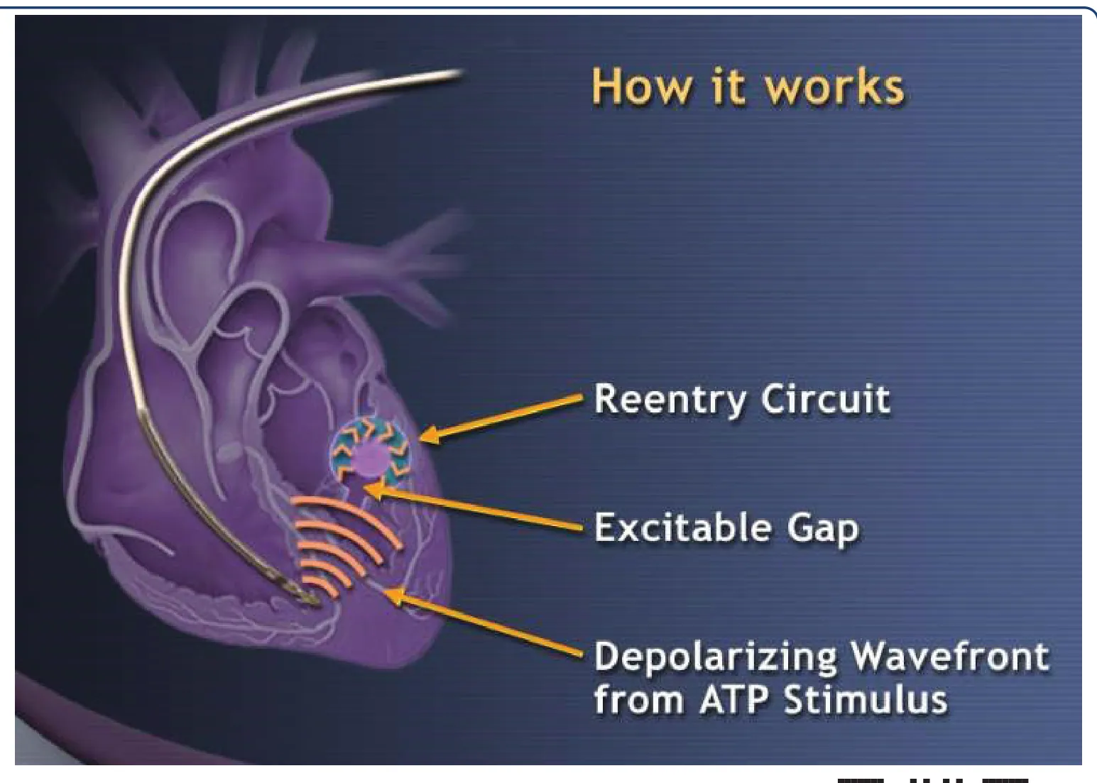 This figure shows how antitachycardia pacing works. Scan the QR code to see a Youtube video made by Dr. Joshua Cooper clearly explaining how ATP works with animations.