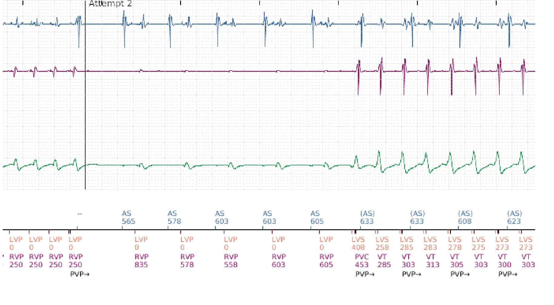 Boston Scientific ICD electrogram, segment 10 of 16 — Anti-tachycardia pacing in the VT zone and post-detection duration