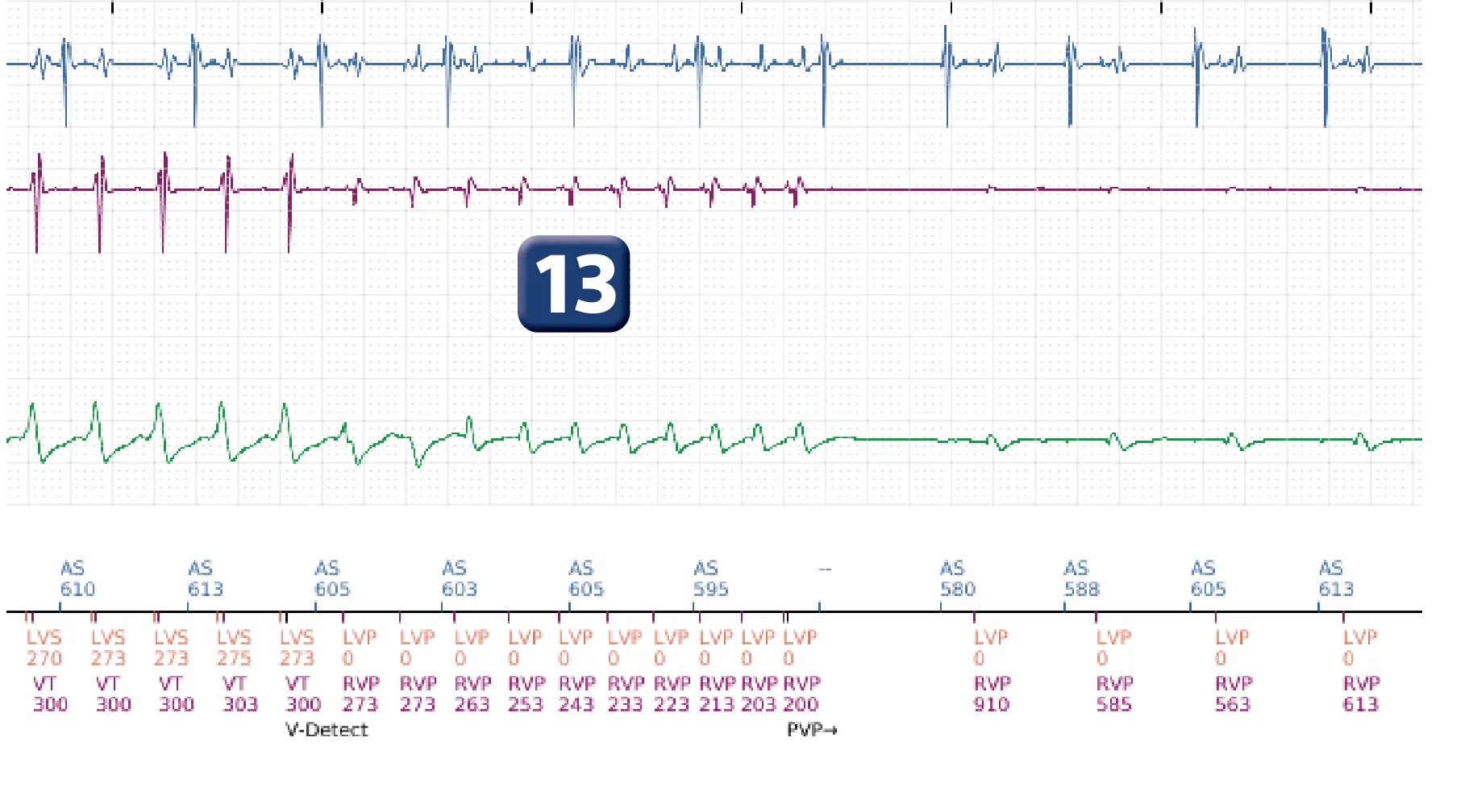 Boston Scientific ICD electrogram, segment 11 of 16 — Anti-tachycardia pacing in the VT zone and post-detection duration