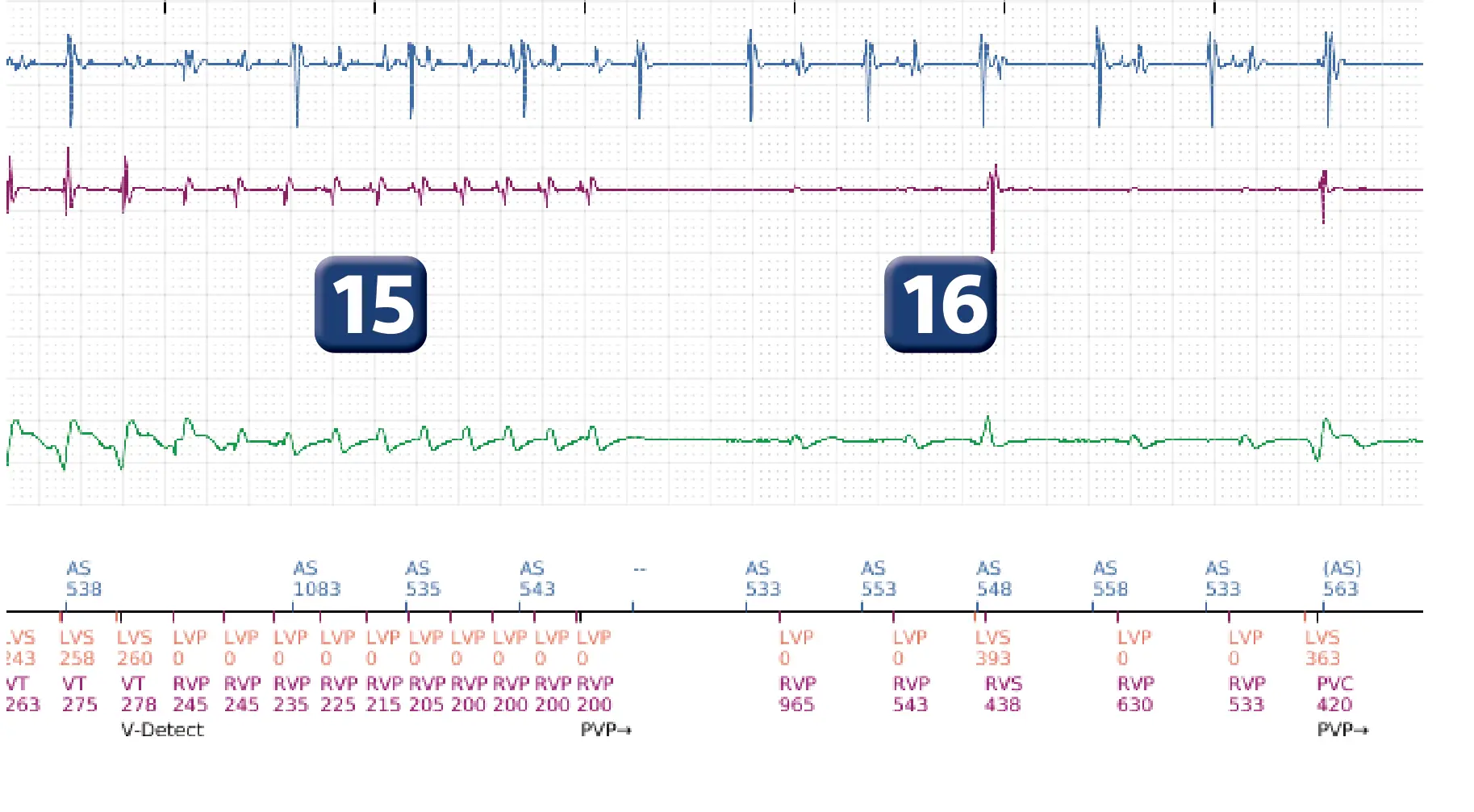 Boston Scientific ICD electrogram, segment 12 of 16 — Progression of therapies in the VT zone