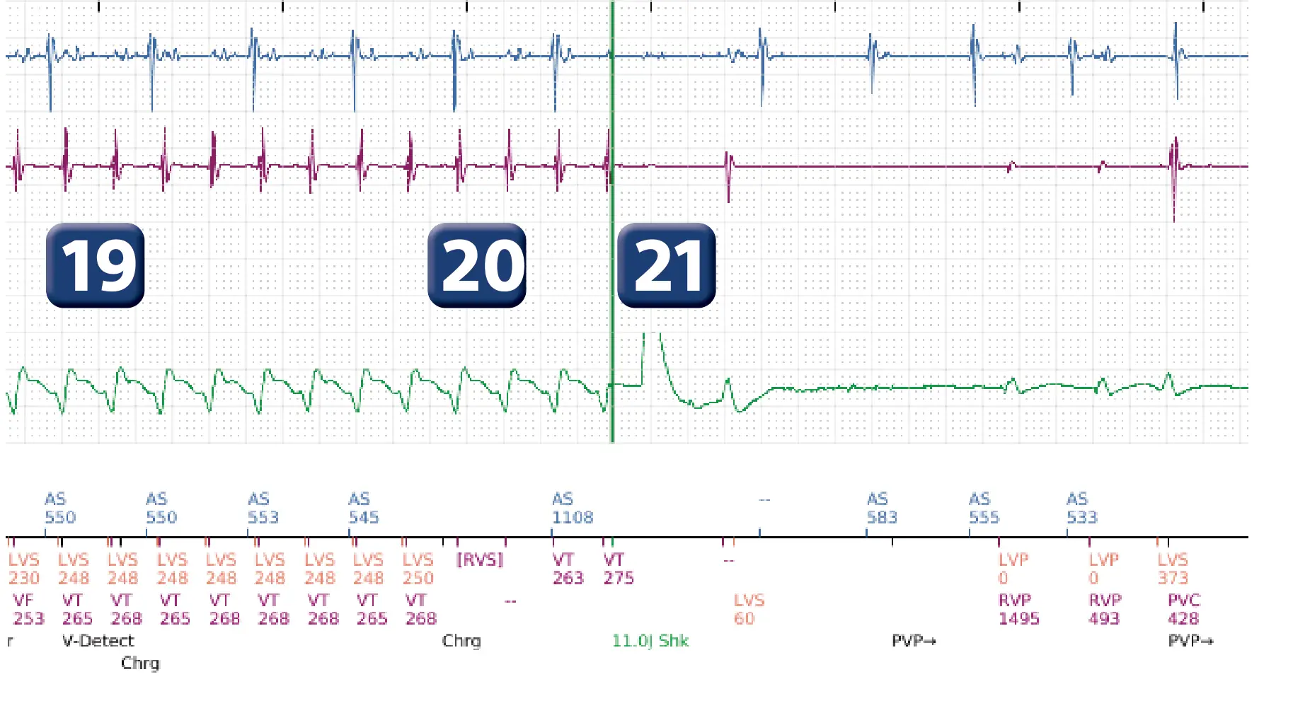 Boston Scientific ICD electrogram, segment 15 of 16 — Progression of therapies in the VT zone