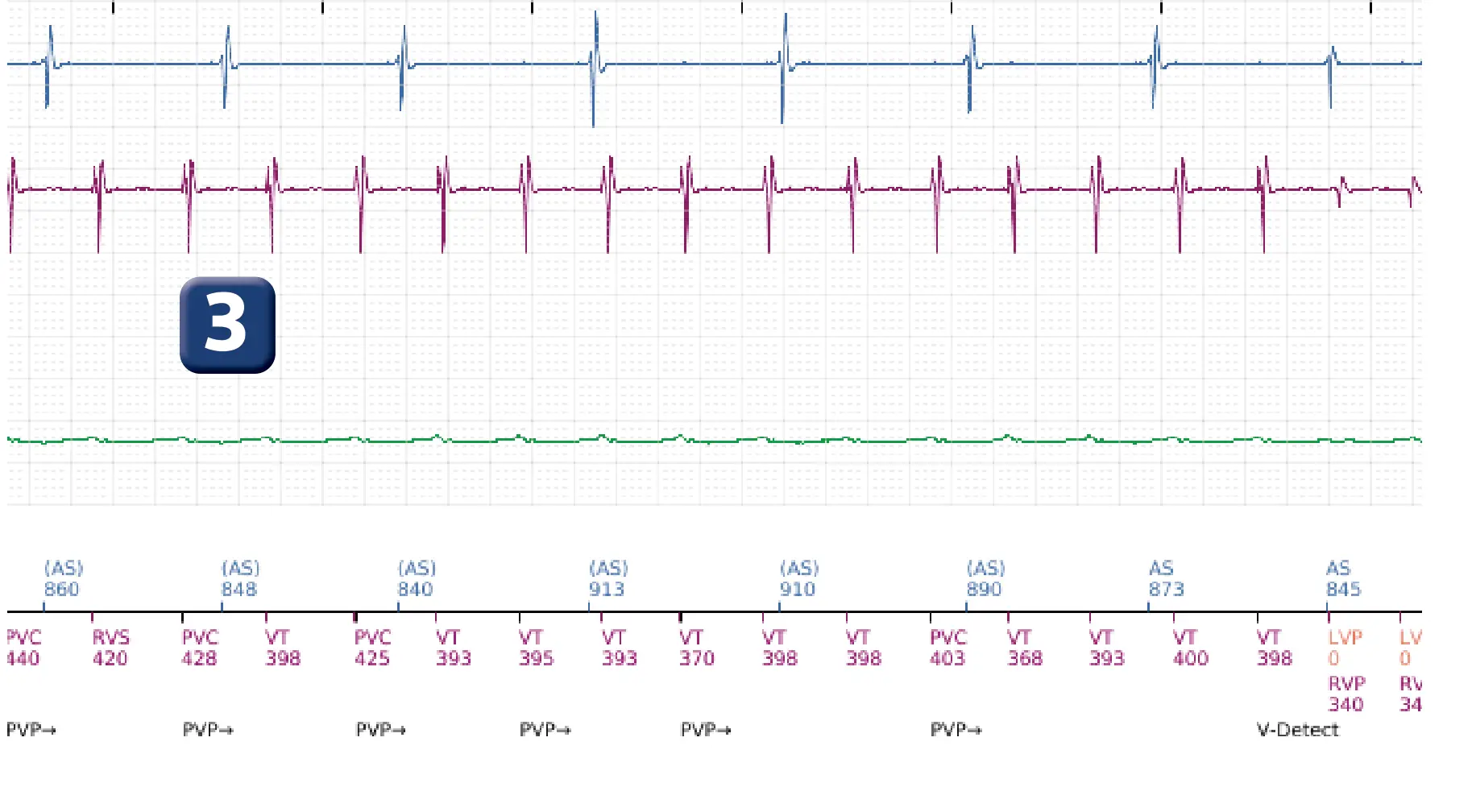 Boston Scientific ICD electrogram, segment 3 of 16 — Low-amplitude shock and acceleration of arrhythmia