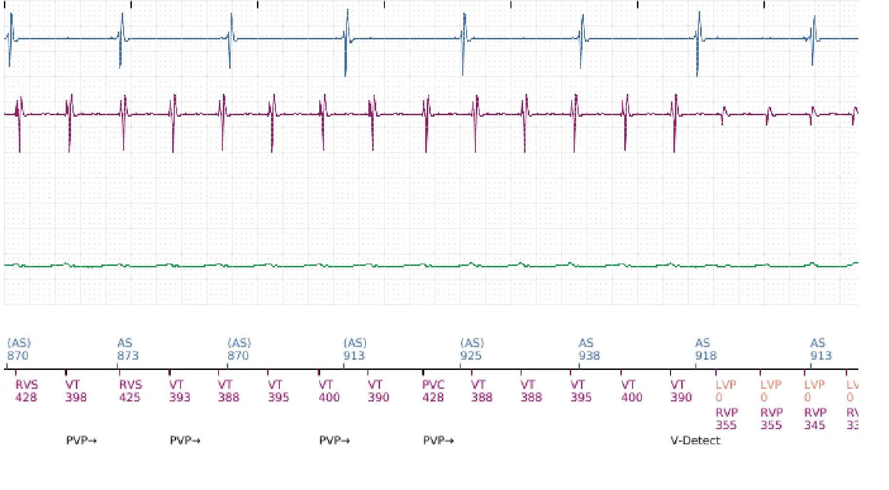 Boston Scientific ICD electrogram, segment 9 of 16 — Low-amplitude shock and acceleration of arrhythmia