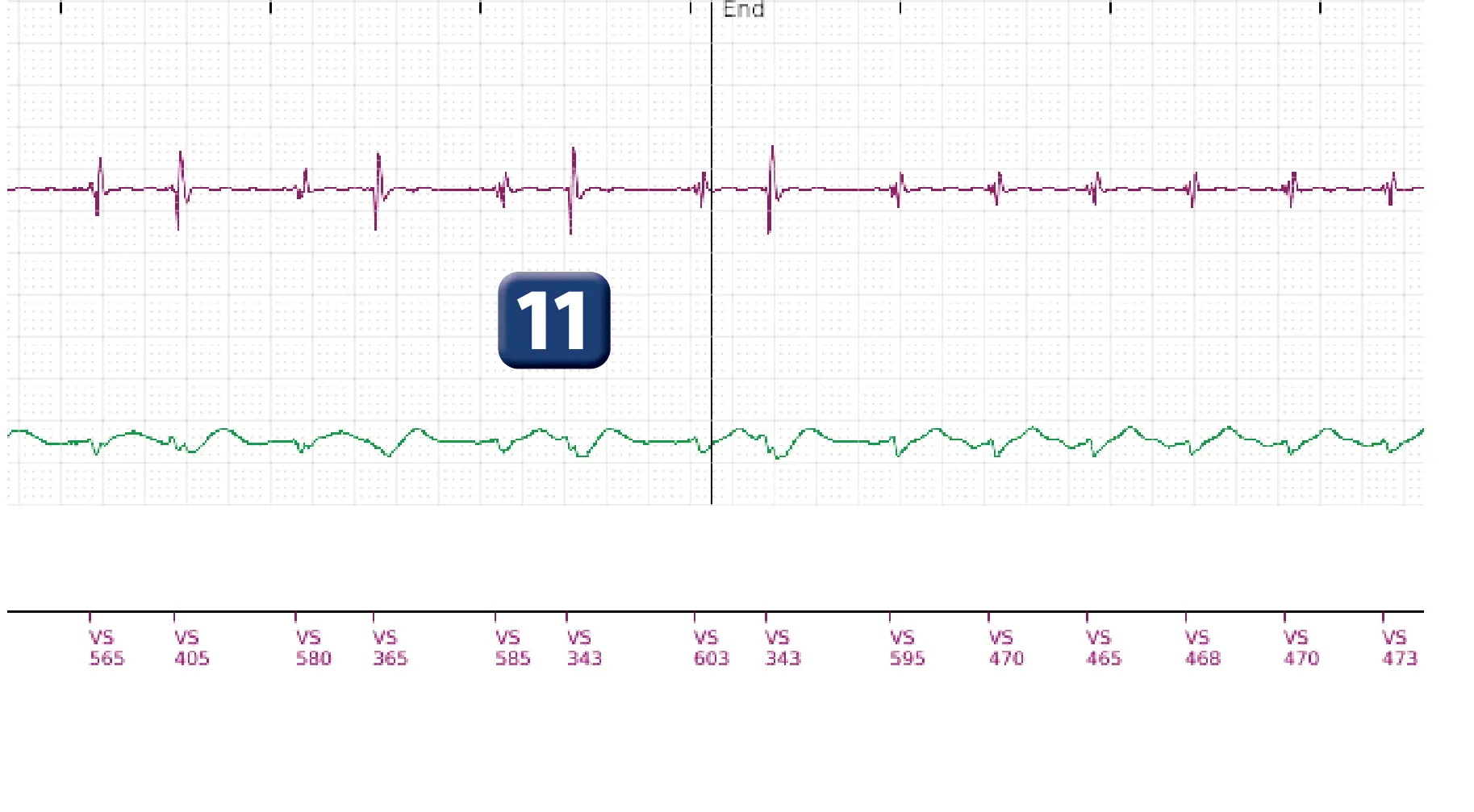 Boston Scientific ICD electrogram, segment 10 of 10 — Maximum output shock in the VT zone