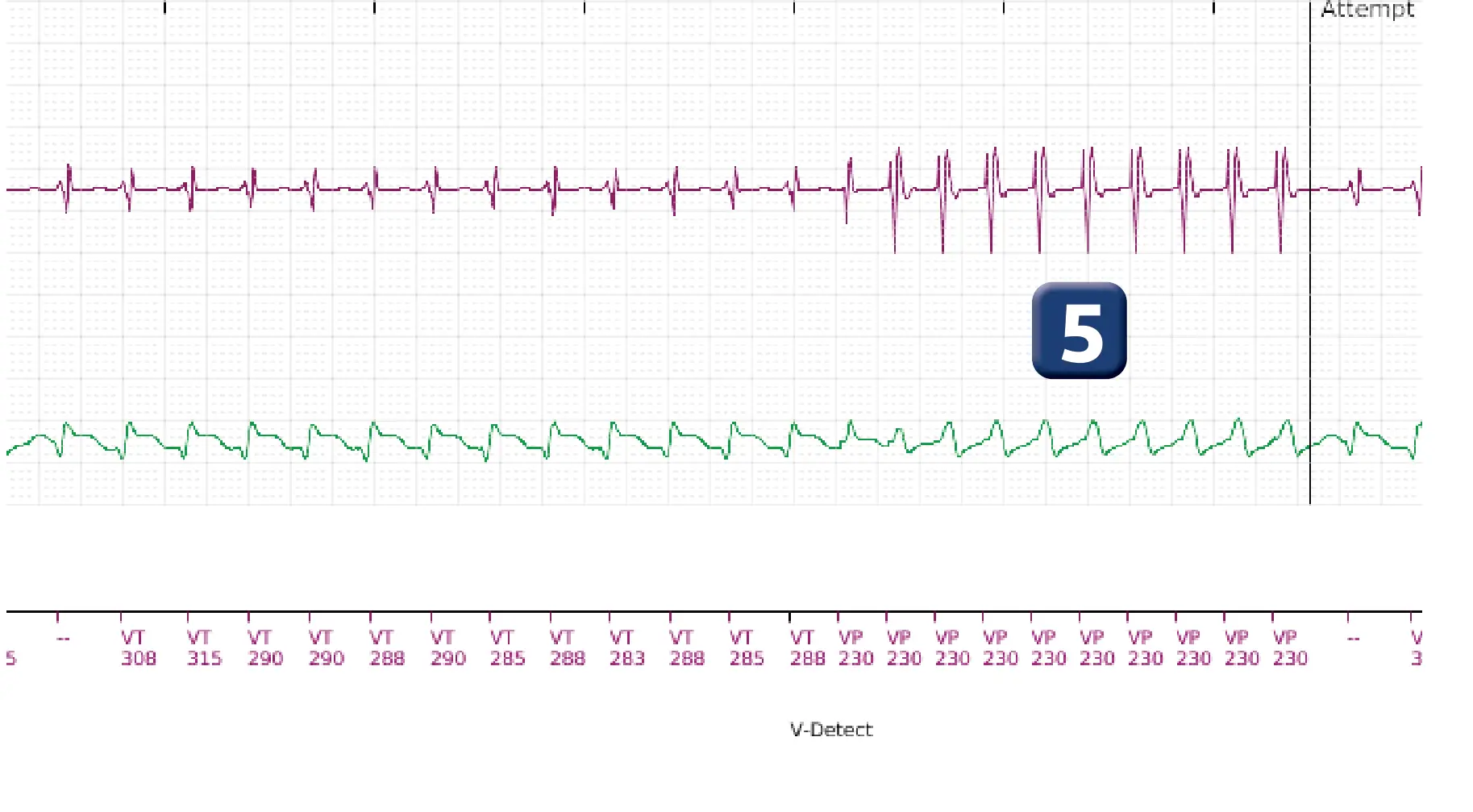 Boston Scientific ICD electrogram, segment 4 of 10 — Maximum output shock in the VT zone