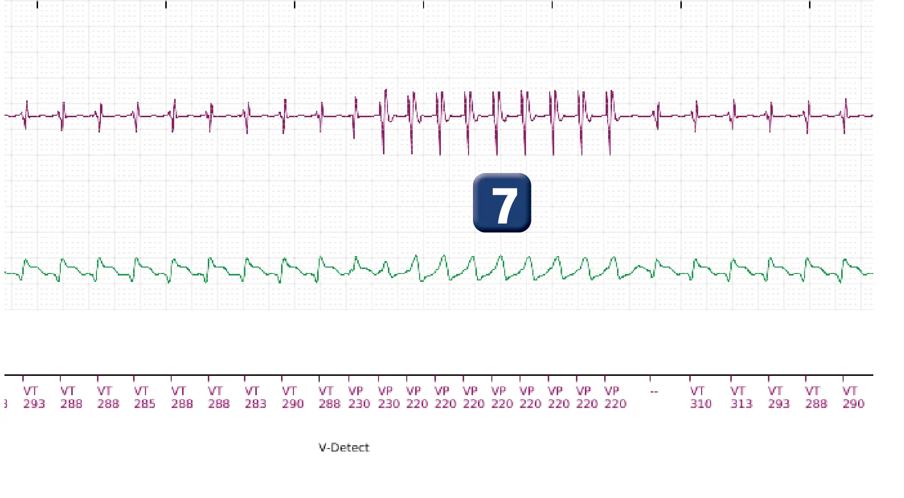Boston Scientific ICD electrogram, segment 6 of 10 — Maximum output shock in the VT zone