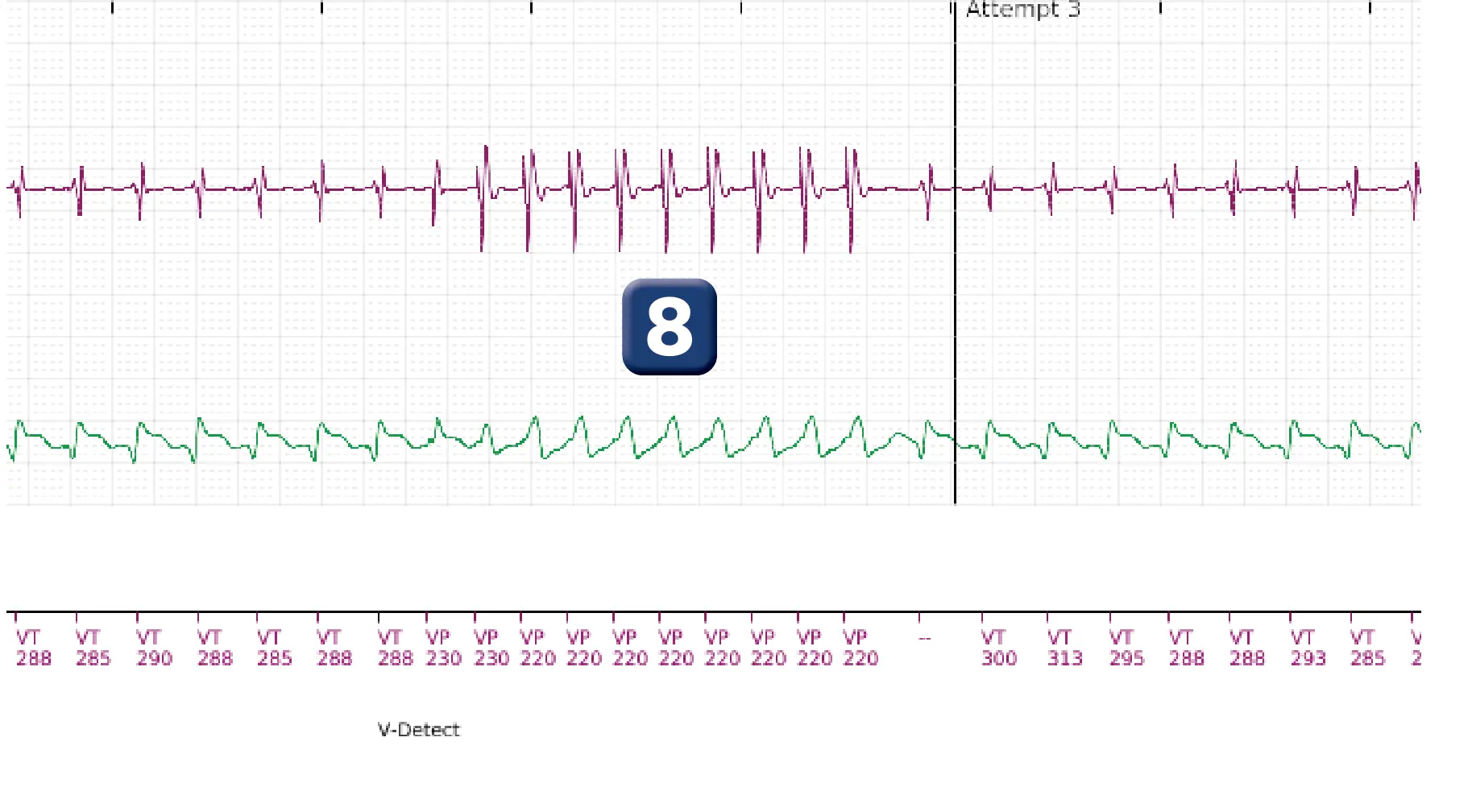 Boston Scientific ICD electrogram, segment 7 of 10 — Maximum output shock in the VT zone