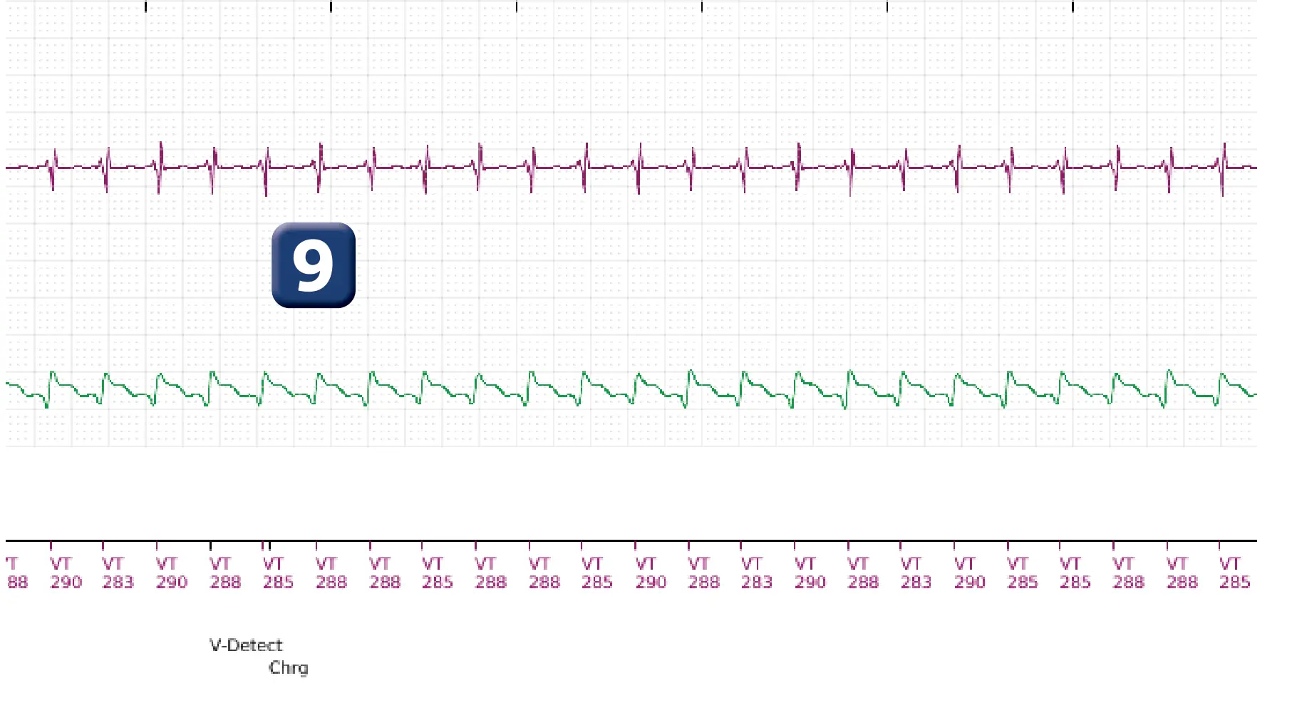 Boston Scientific ICD electrogram, segment 8 of 10 — Maximum output shock in the VT zone