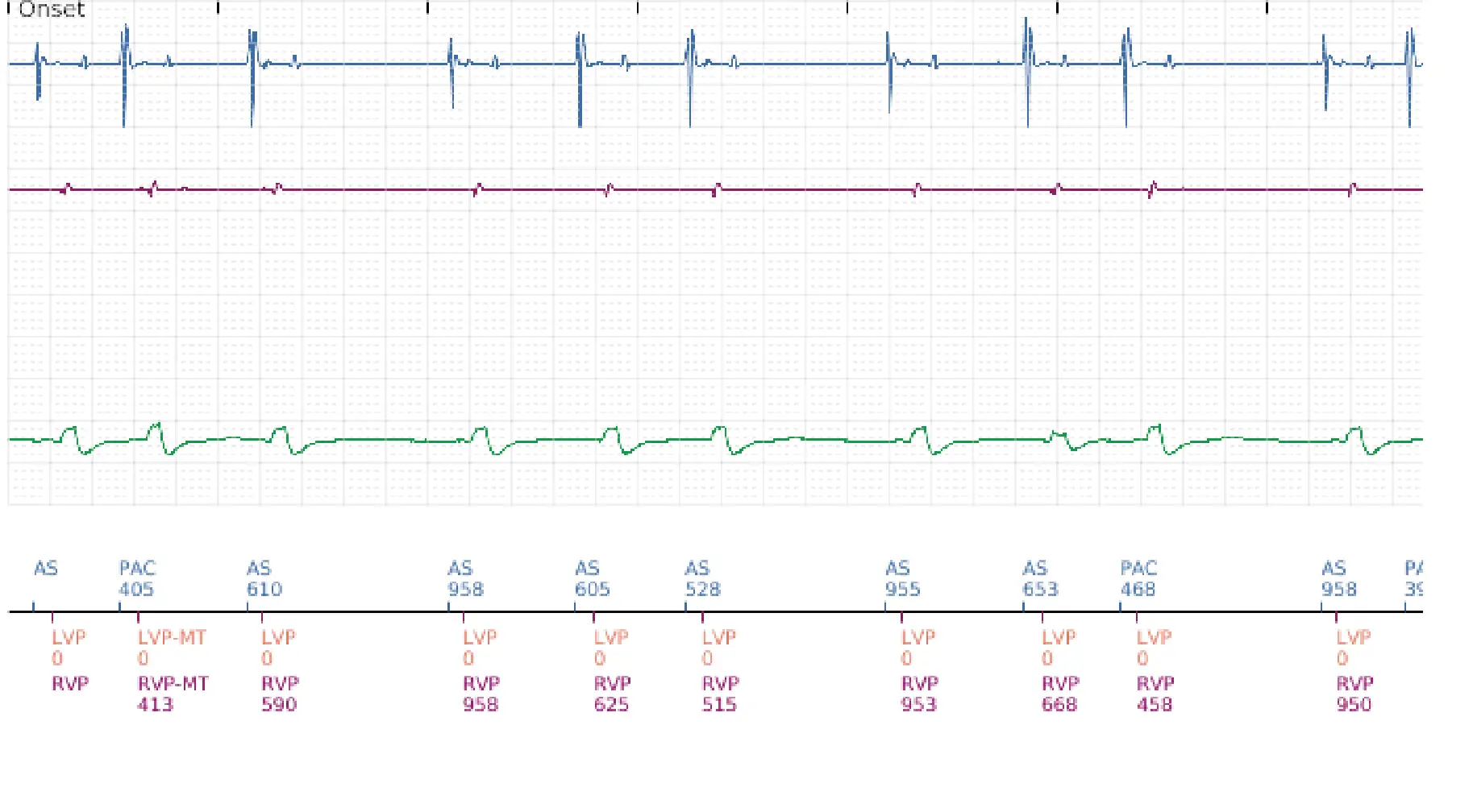 Boston Scientific ICD electrogram, segment 1 of 6 — Anti-tachycardia pacing in the VT zone with acceleration into the VF zone