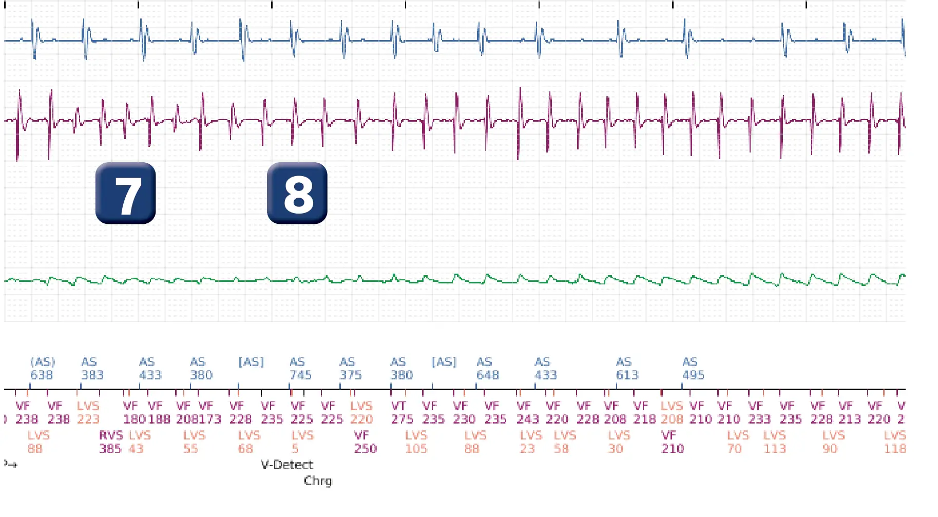 Boston Scientific ICD electrogram, segment 5 of 12 — Multiple electric shocks in the VF zone