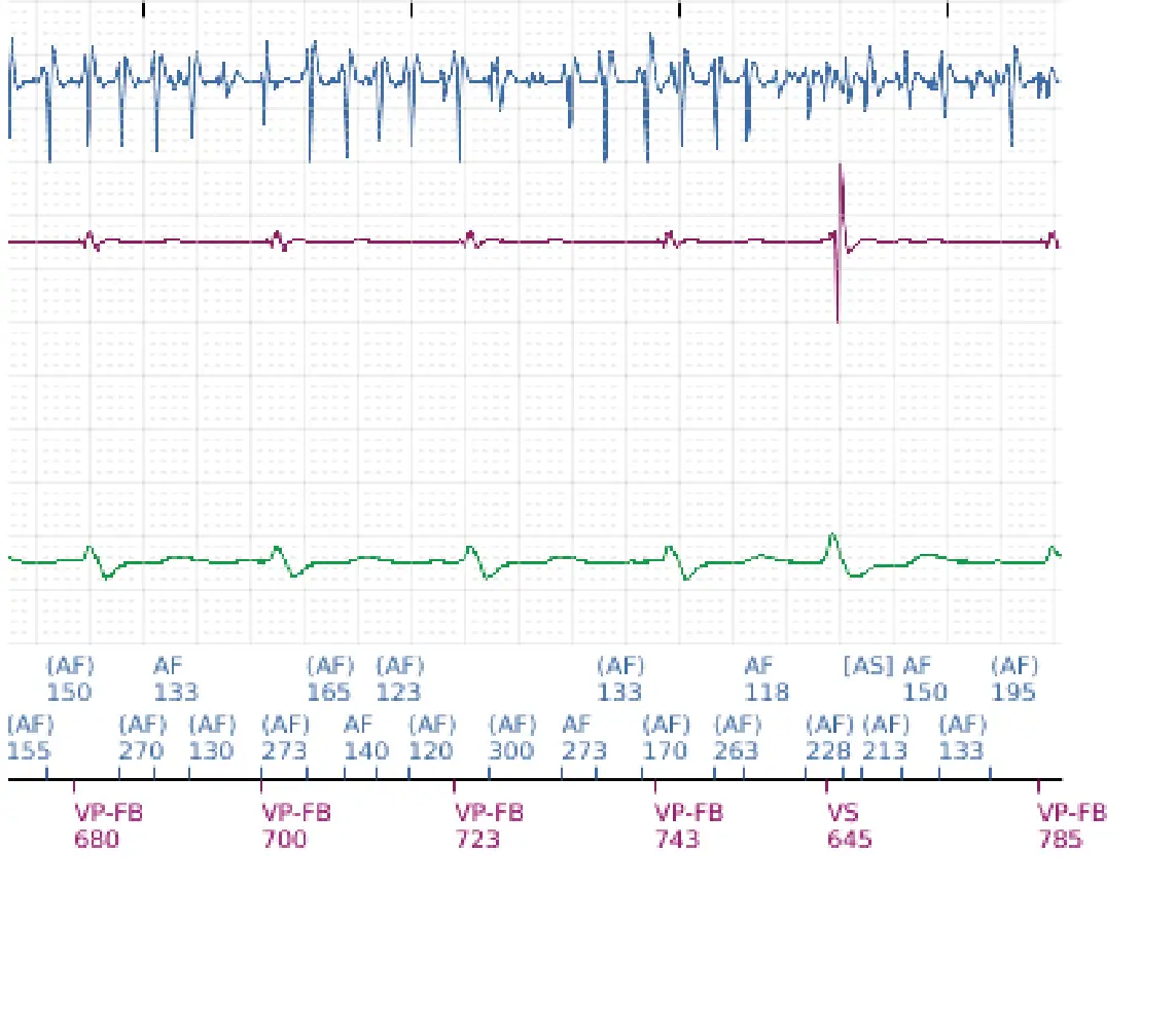 Boston Scientific ICD electrogram, segment 7 of 7 — VF, device shock with AF induction