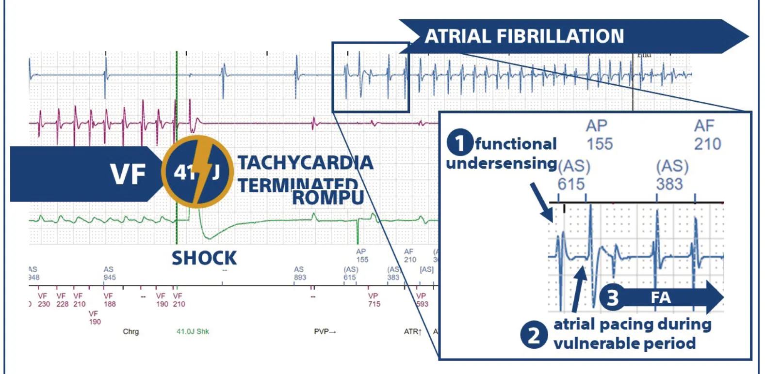 The tracing shows how the shock delivered during VF terminates ventricular arrhythmia, with immediate onset of AF (probable combined effect of the pro-arrhythmogenic effect of the shock and atrial pacing in a vulnerable period).