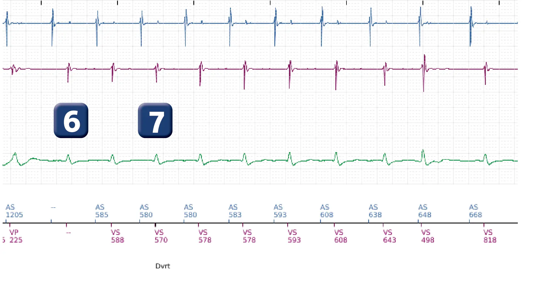 Boston Scientific ICD electrogram, segment 3 of 12 — ATP burst in the VF zone